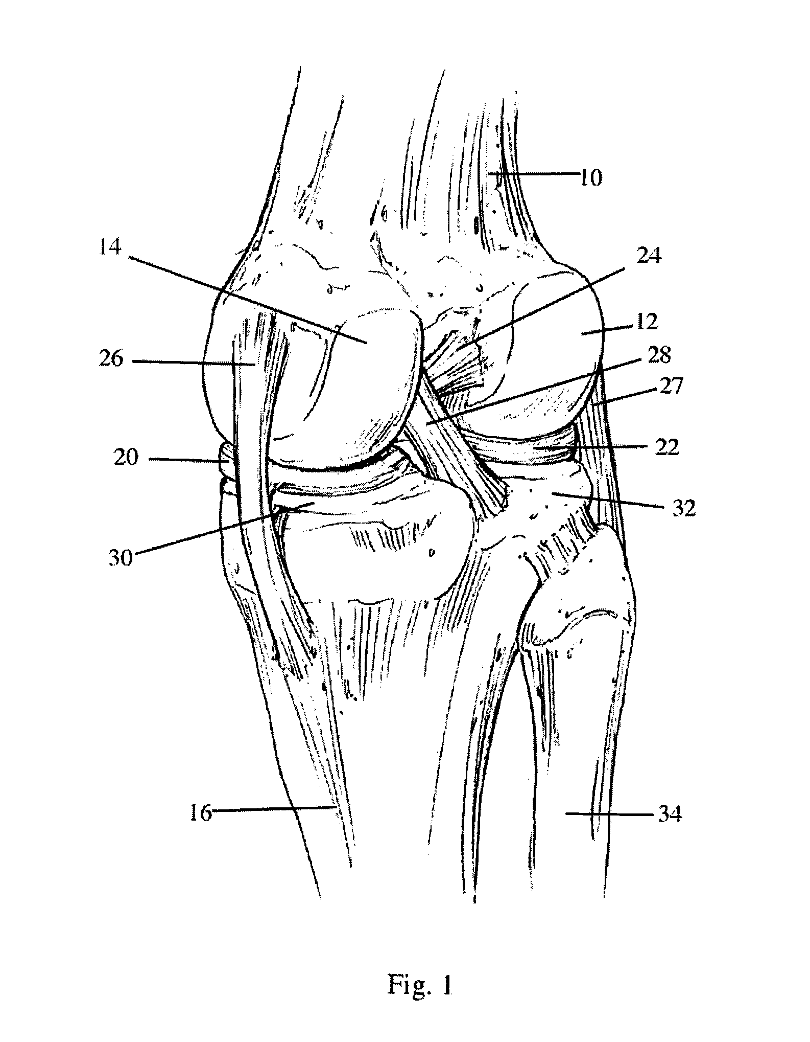 Bicompartmental implants and method of use