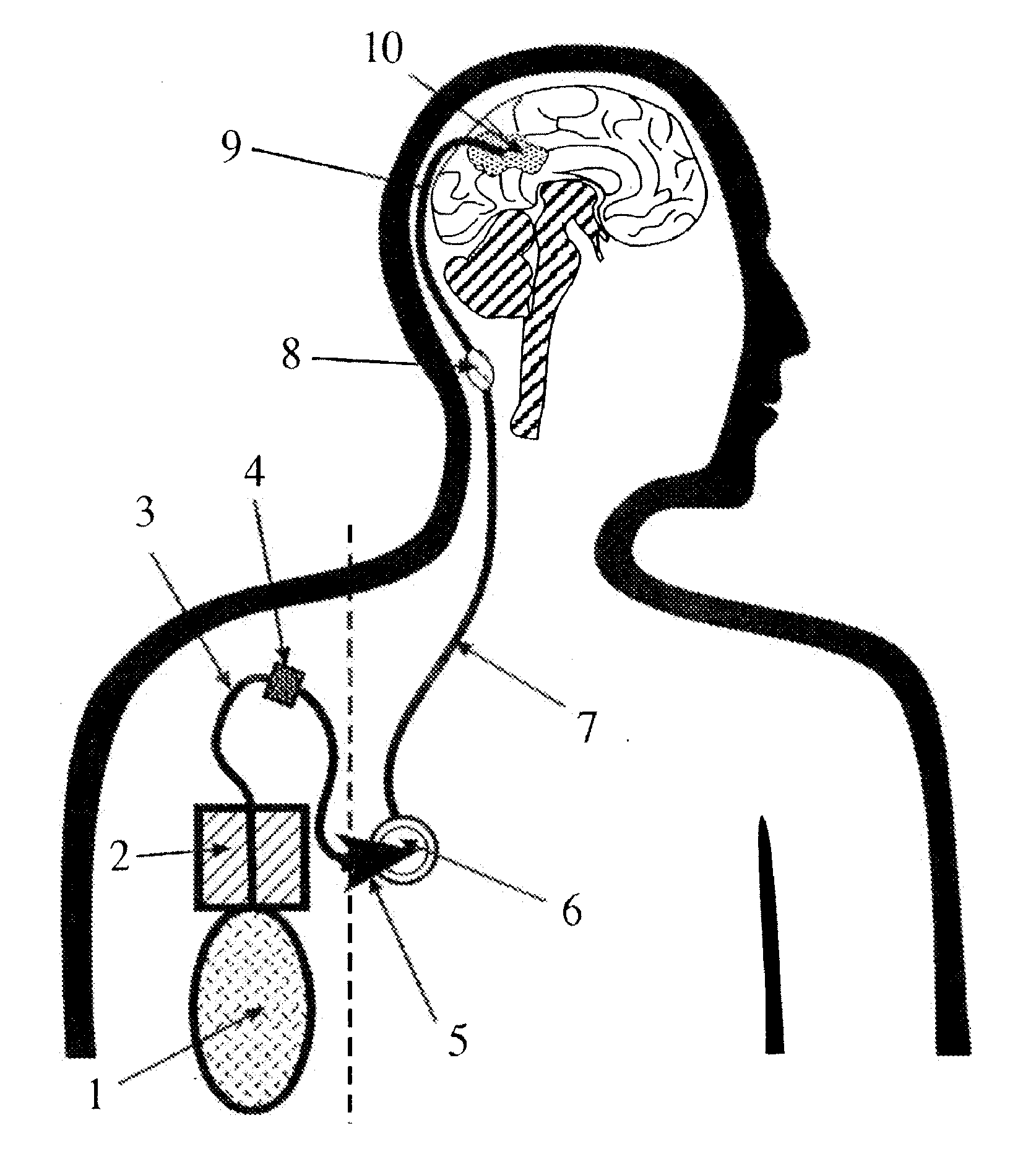 Portable equipment for administration of fluids into tissues and tumors by convection enhanced delivery technique