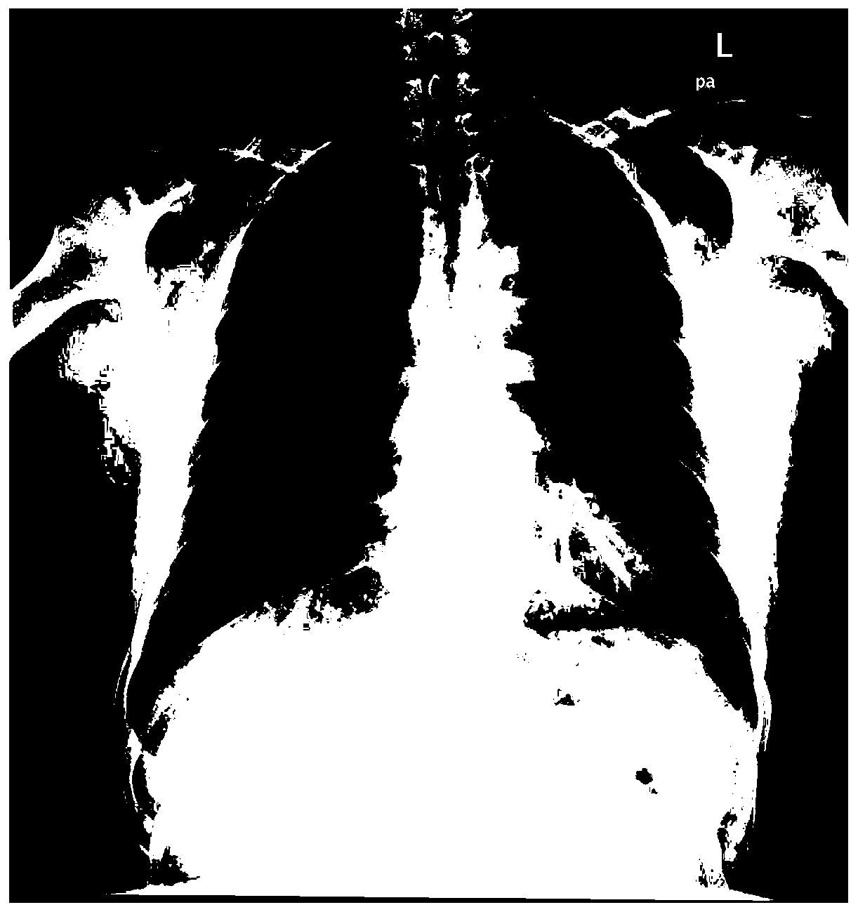 Lung tissue image segmentation method based on deep learning