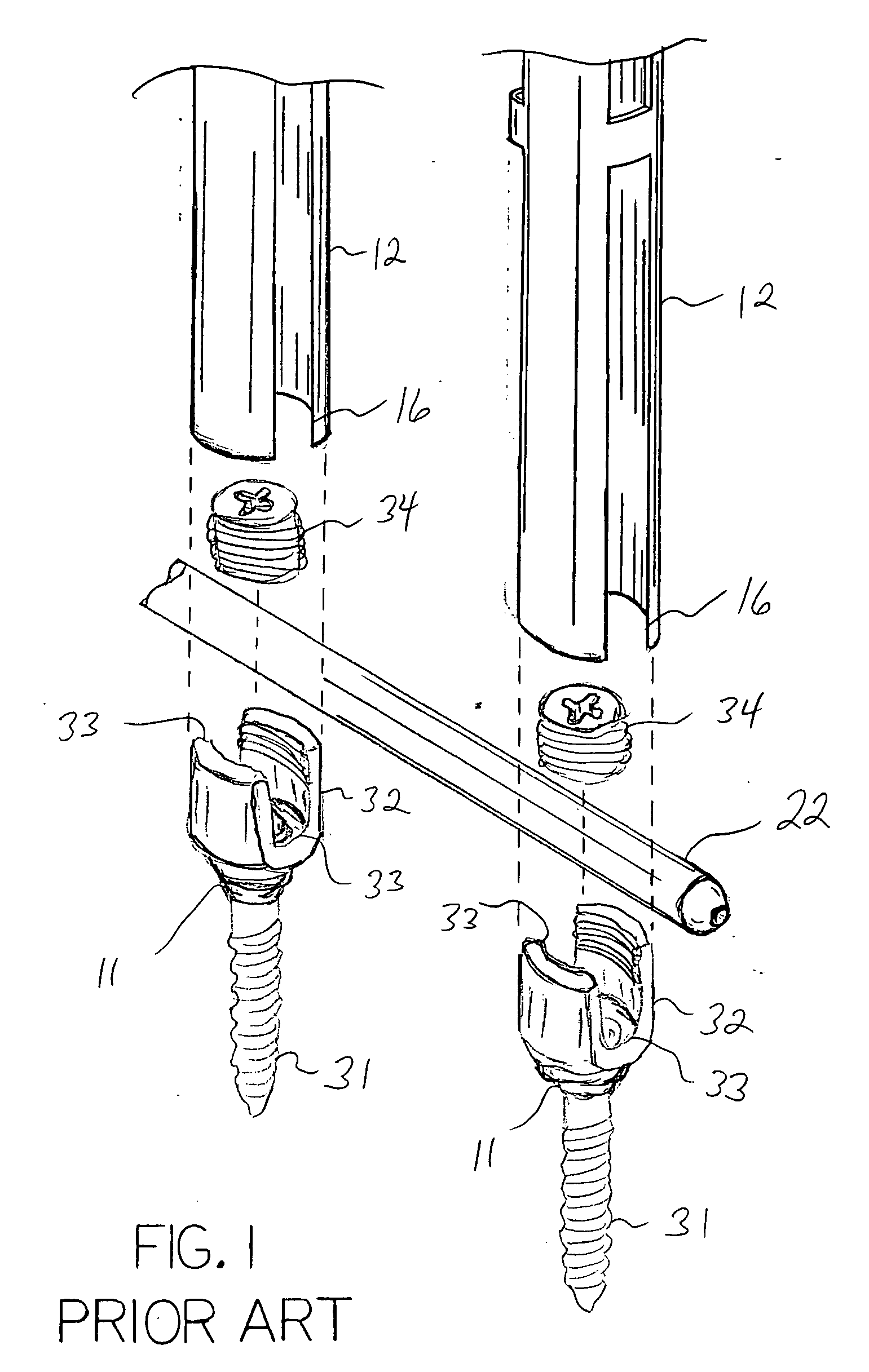 Guide wire mounting collar for spinal fixation using minimally invasive surgical techniques