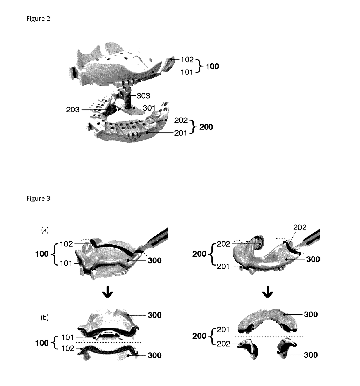 Method and apparatus for preparing removable dental prosthesis