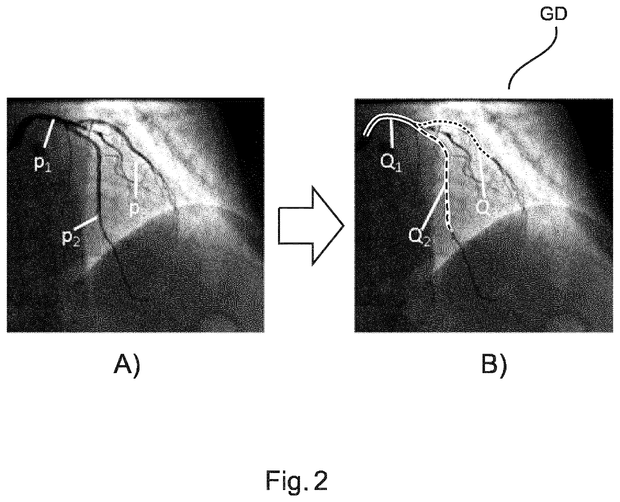 Estimating flow, resistance or pressure from pressure or flow measurements and angiography