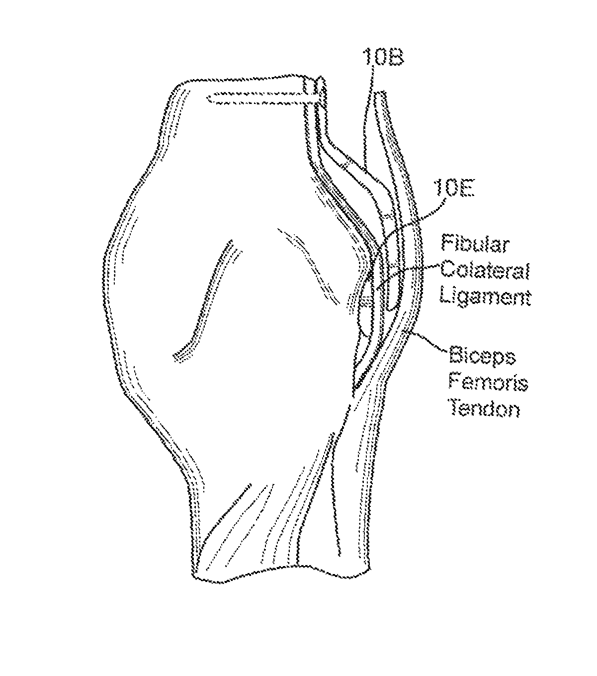 Method and apparatus for force redistribution in articular joints