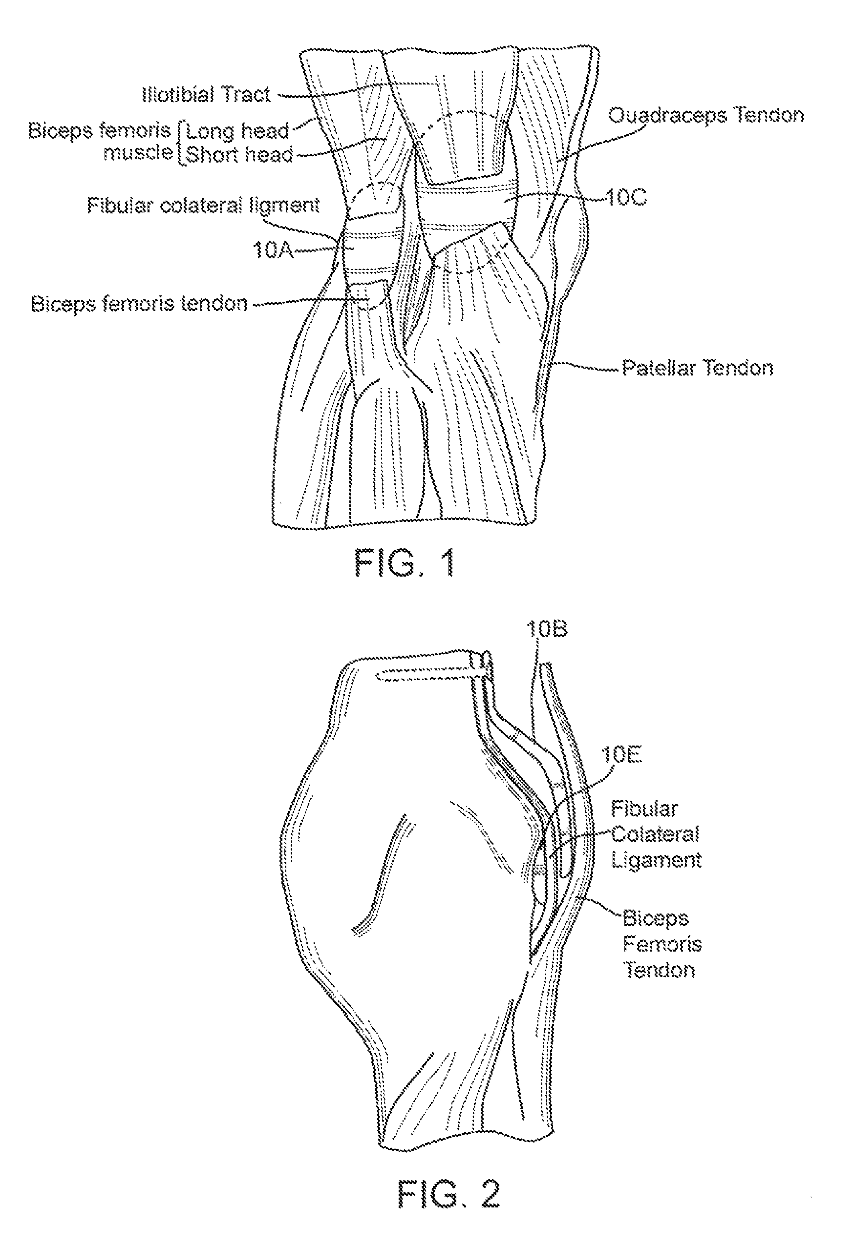 Method and apparatus for force redistribution in articular joints