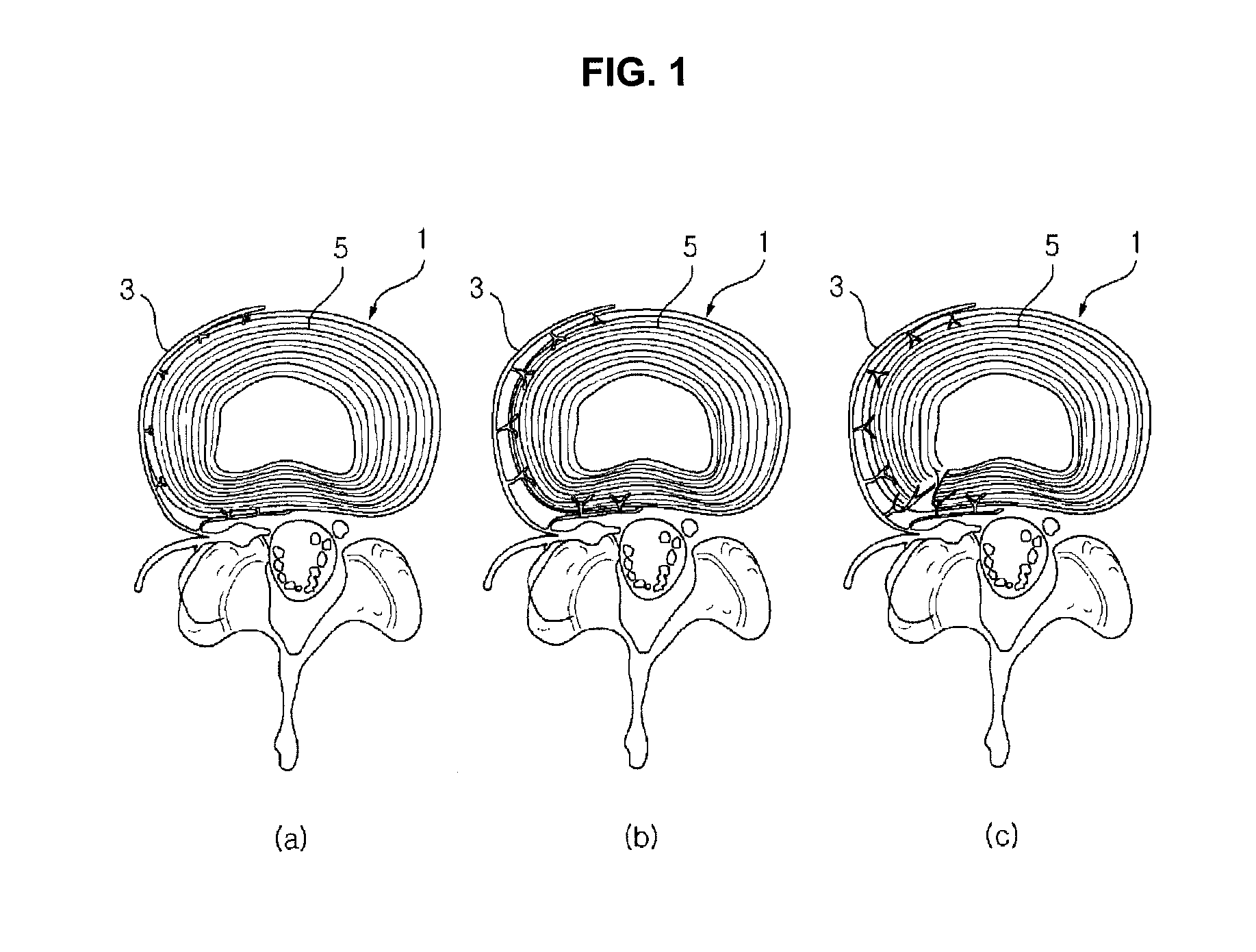 Probe and device for detecting abnormality of intervertebral disc