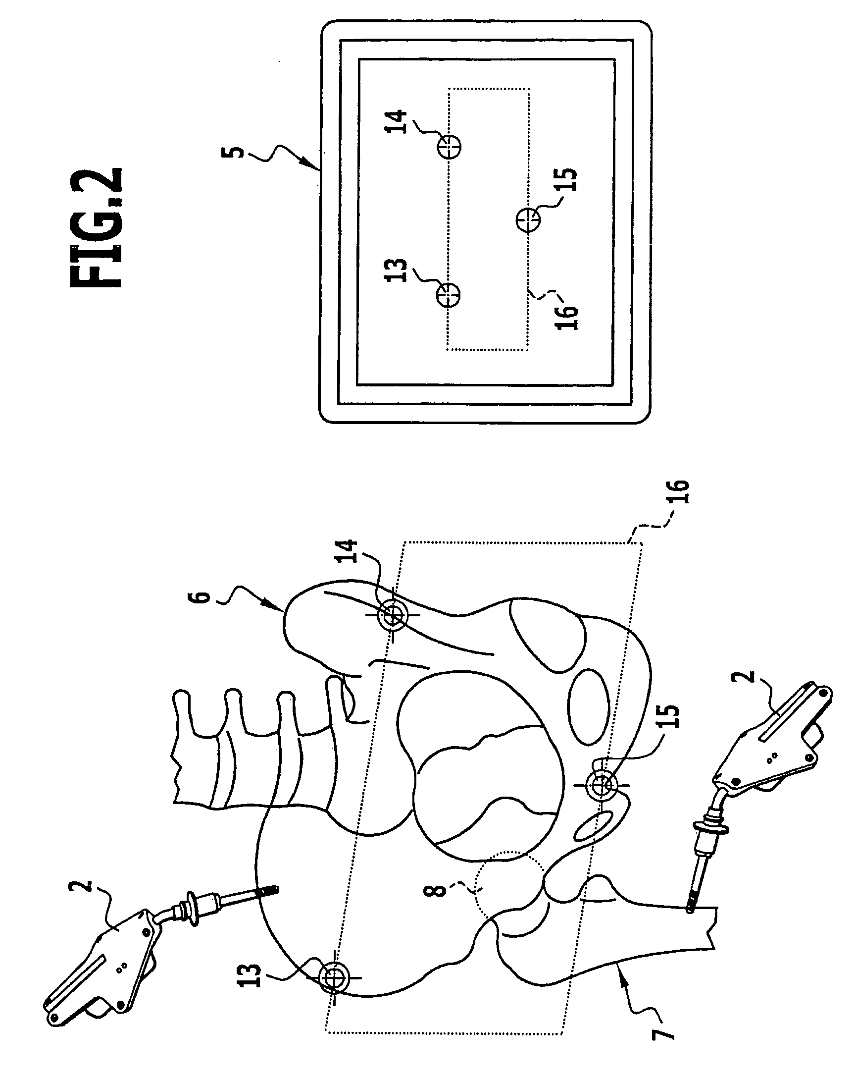 Method and surgical navigation system for creating a recess to receive an acetabulum