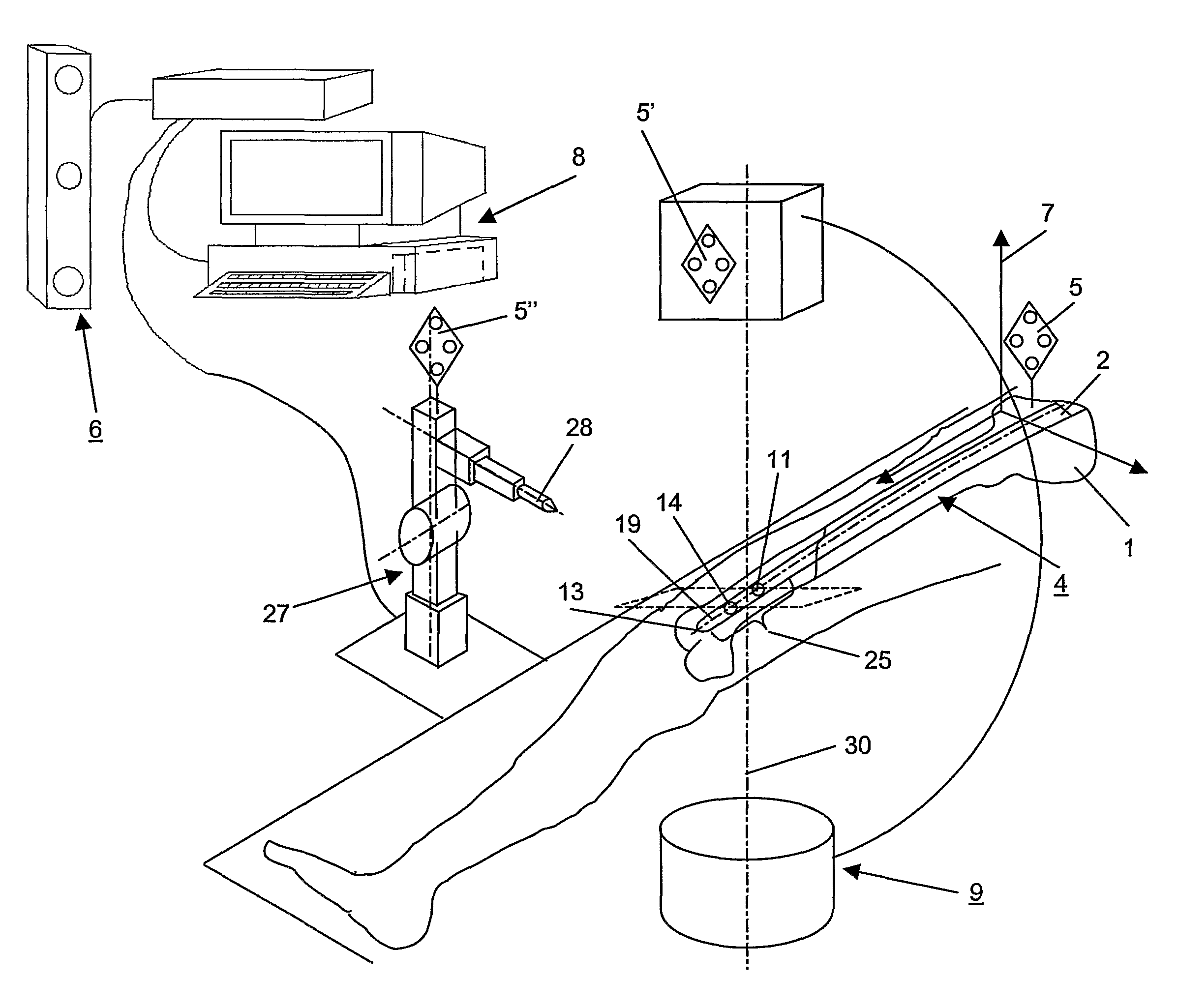 Method and Device for Computer Assisted Distal Locking of Intramedullary Nails