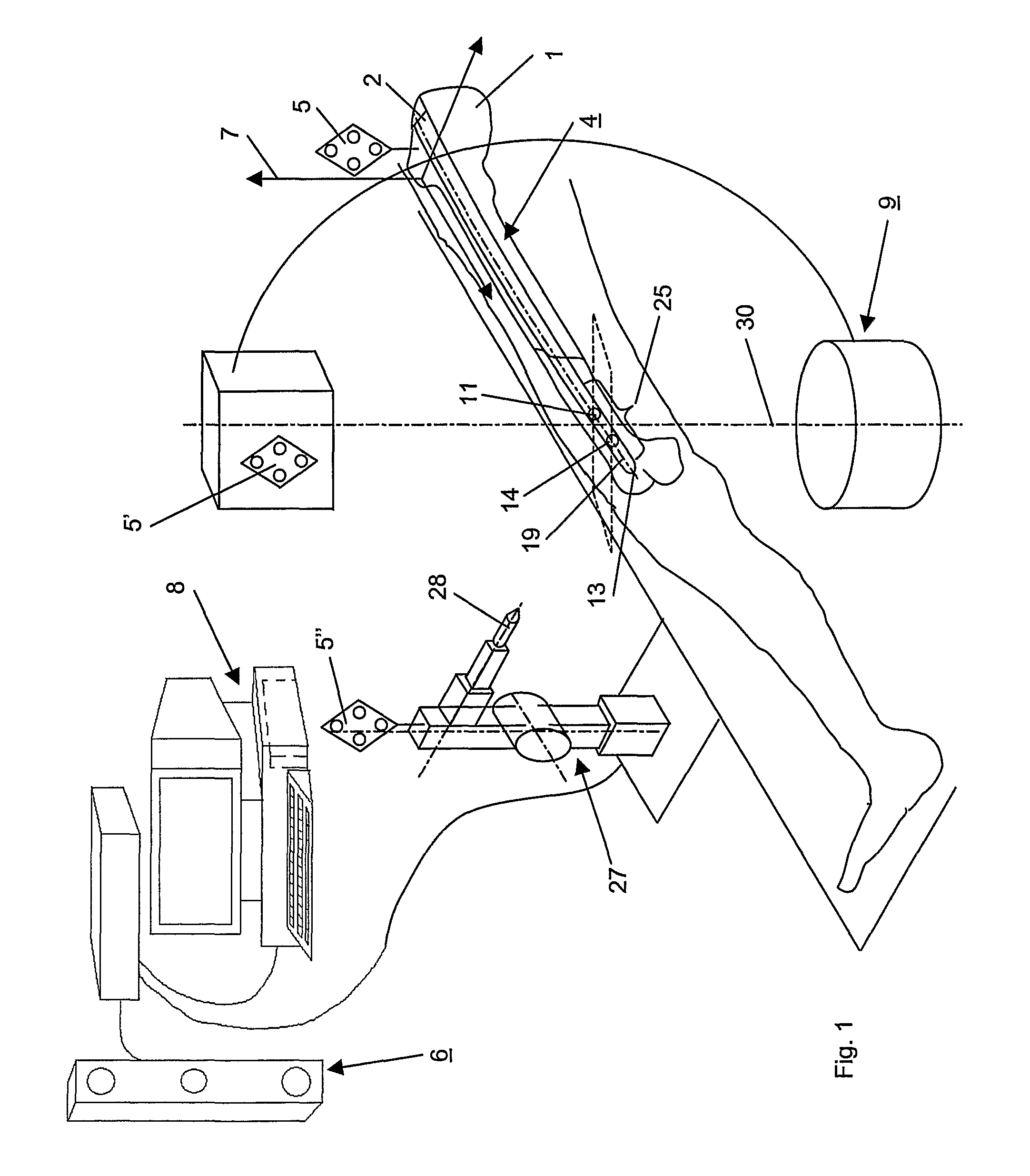 Method and Device for Computer Assisted Distal Locking of Intramedullary Nails