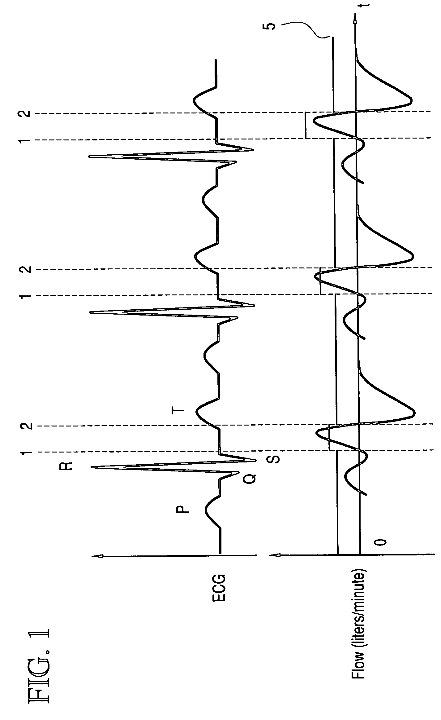 Method for operating an anesthesia or ventilation apparatus having a trigger function and devcie therefor