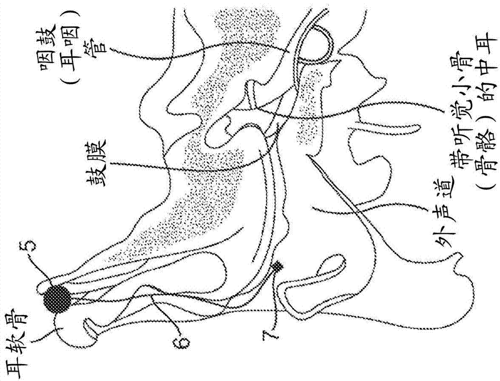 Bone conduction hearing device with open-ear microphone
