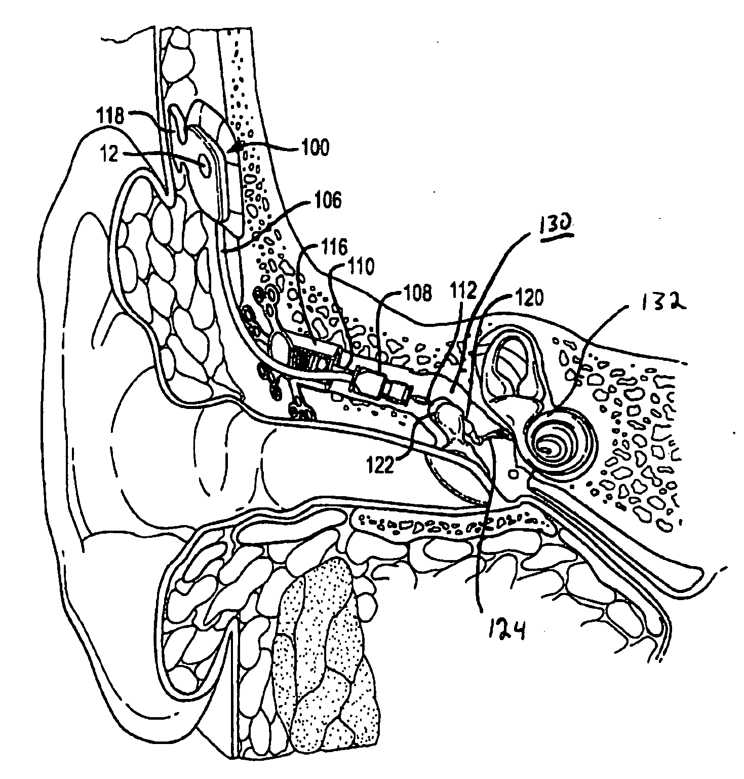 Spanning connector for implantable hearing instrument