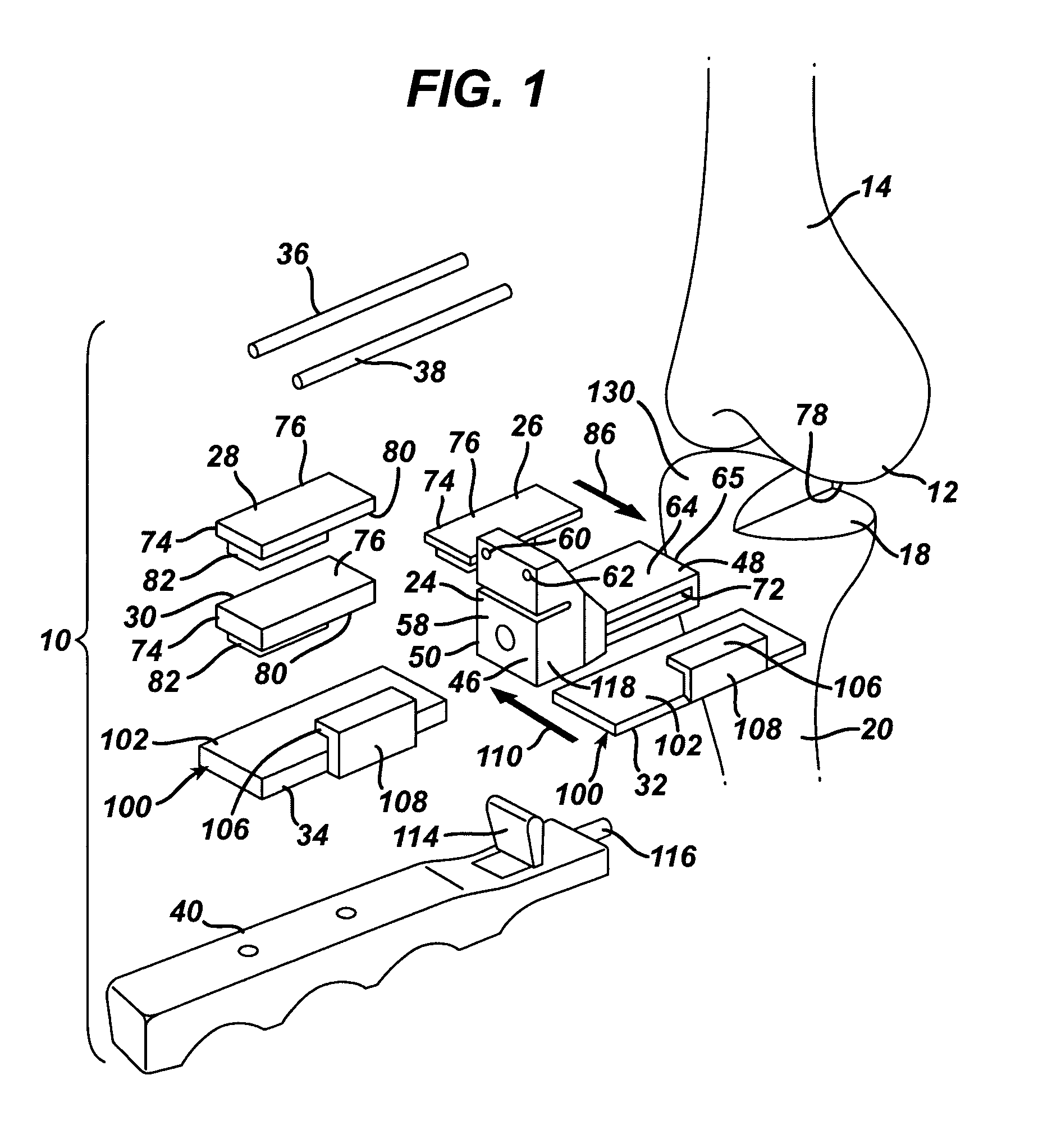 Kit, guide and method for locating distal femoral resection plane
