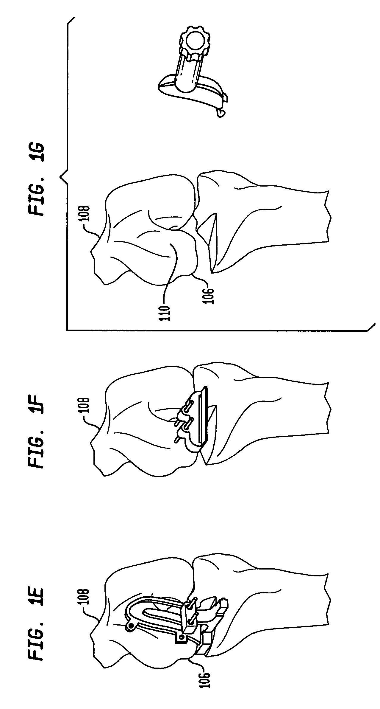 Unicondylar knee cutting guide