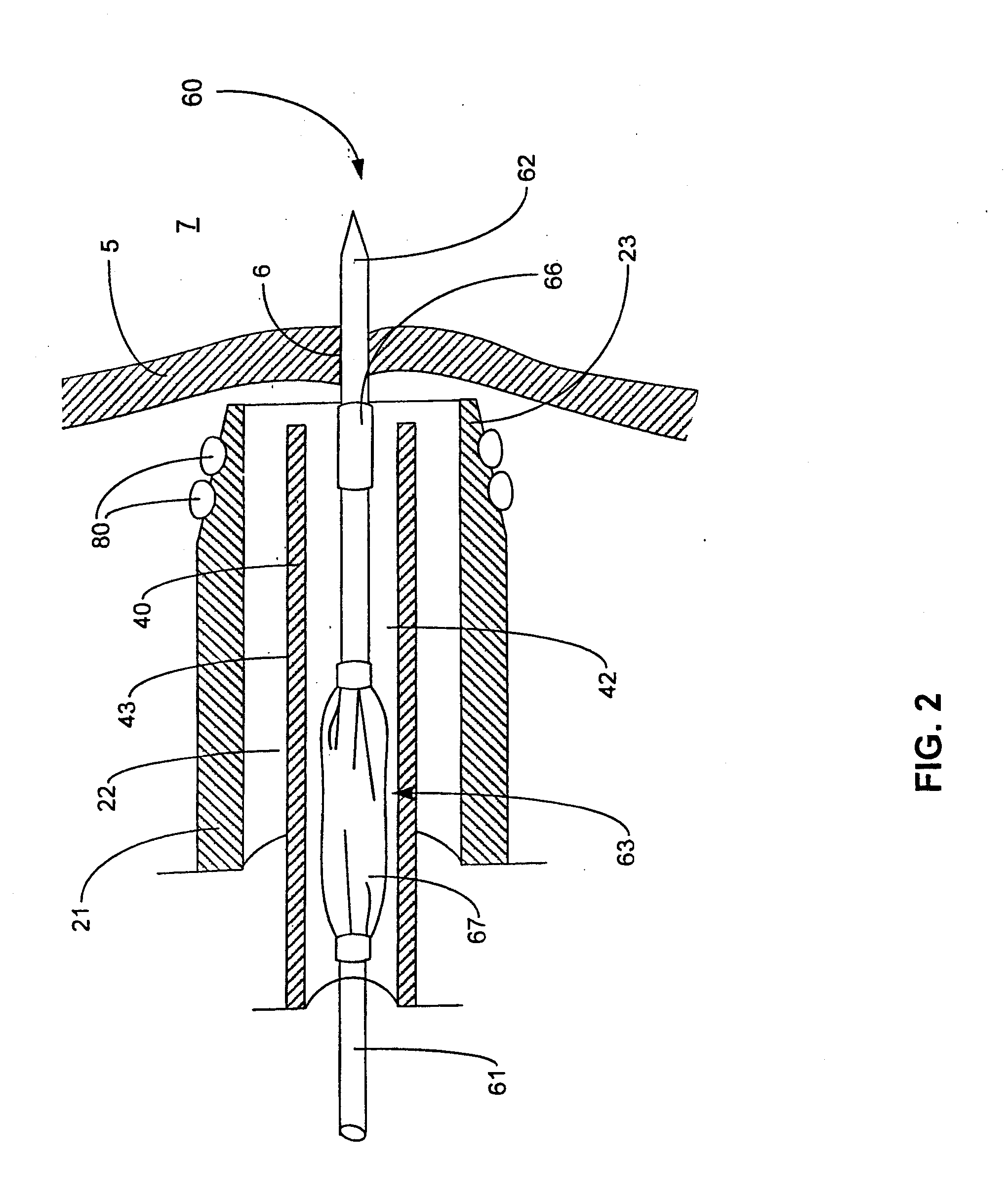 Tissue securing and sealing apparatus and related methods of use