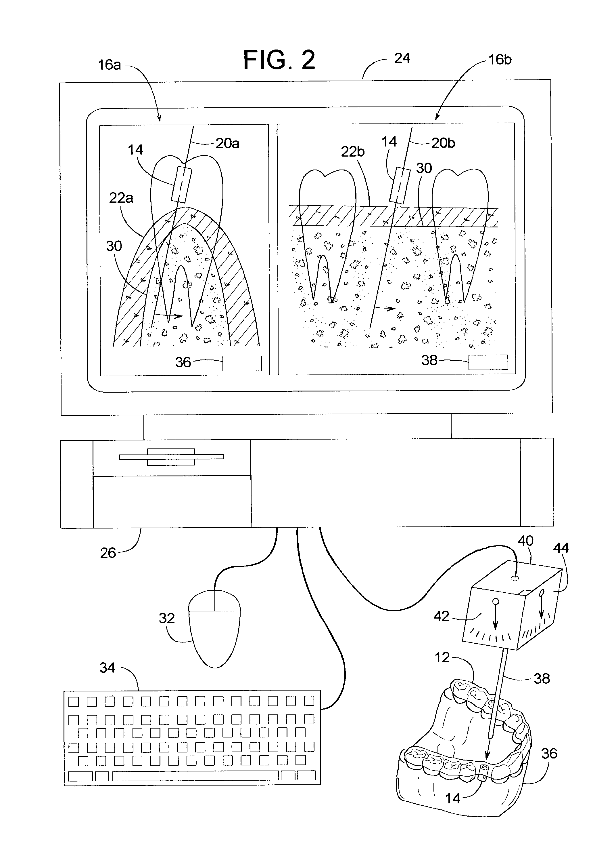 Method of adjusting a drill bushing for a dental implant