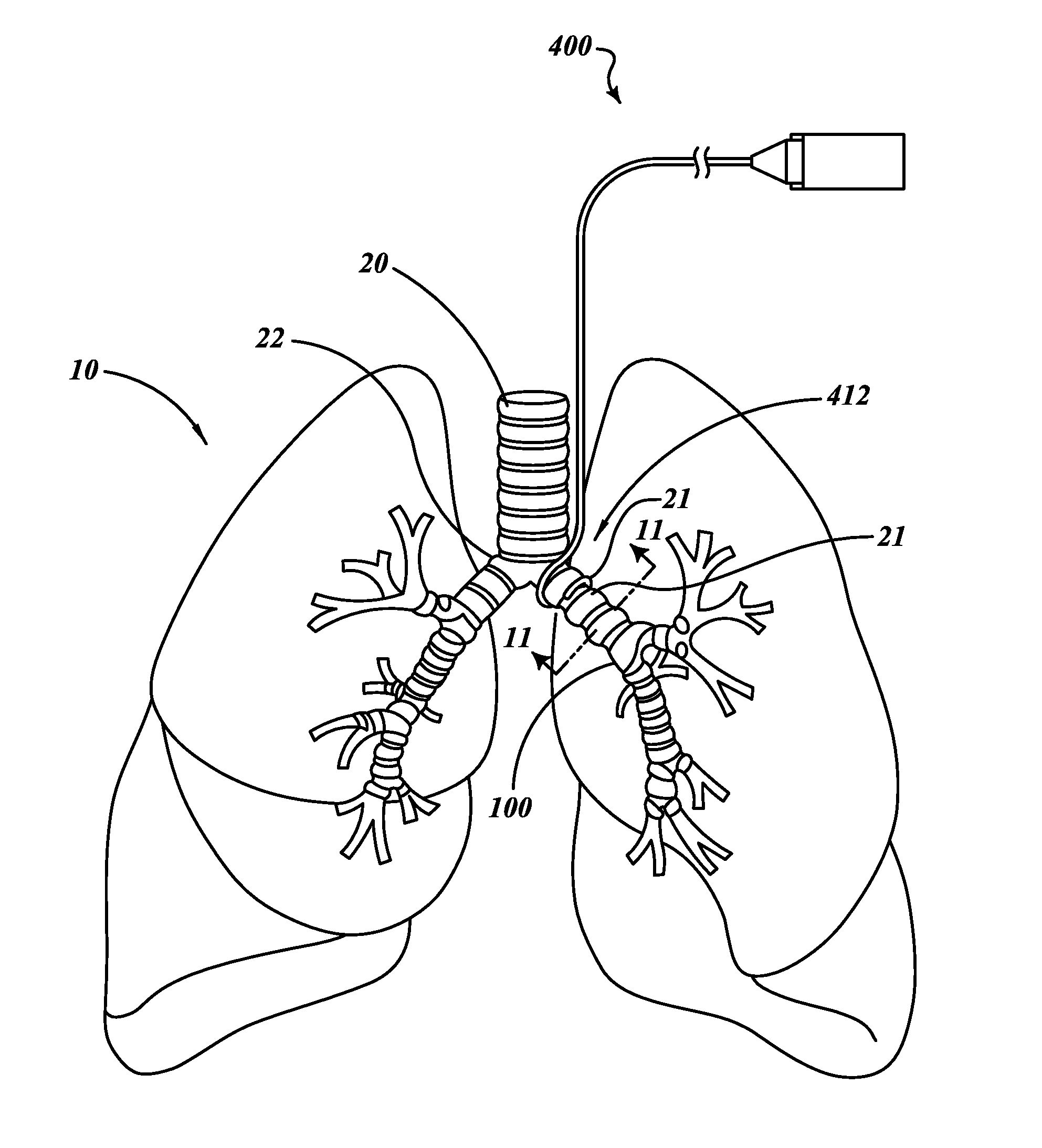 Non-invasive and minimally invasive denervation methods and systems for performing the same