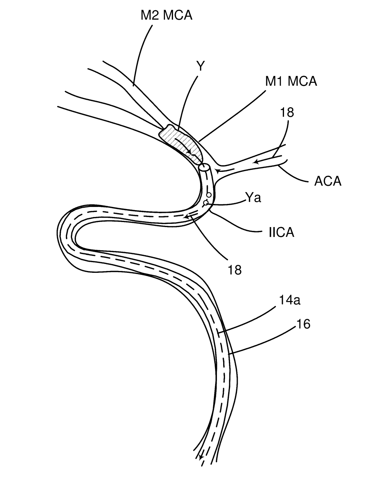 Systems and methods to improve perfusion pressure during endovascular intervention