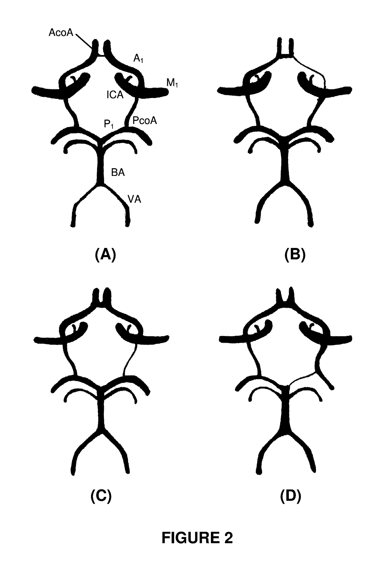 Systems and methods to improve perfusion pressure during endovascular intervention