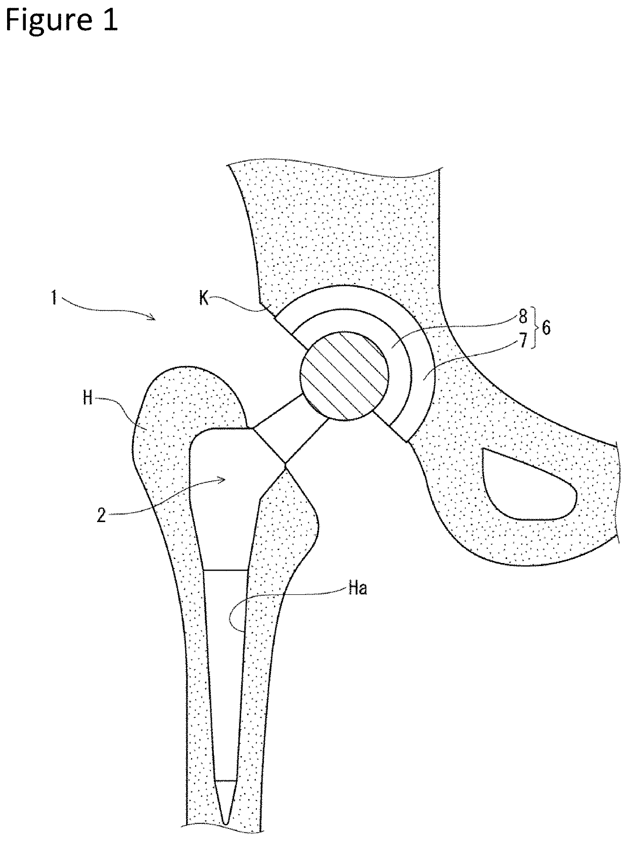 Stem, femoral component, hip prosthesis