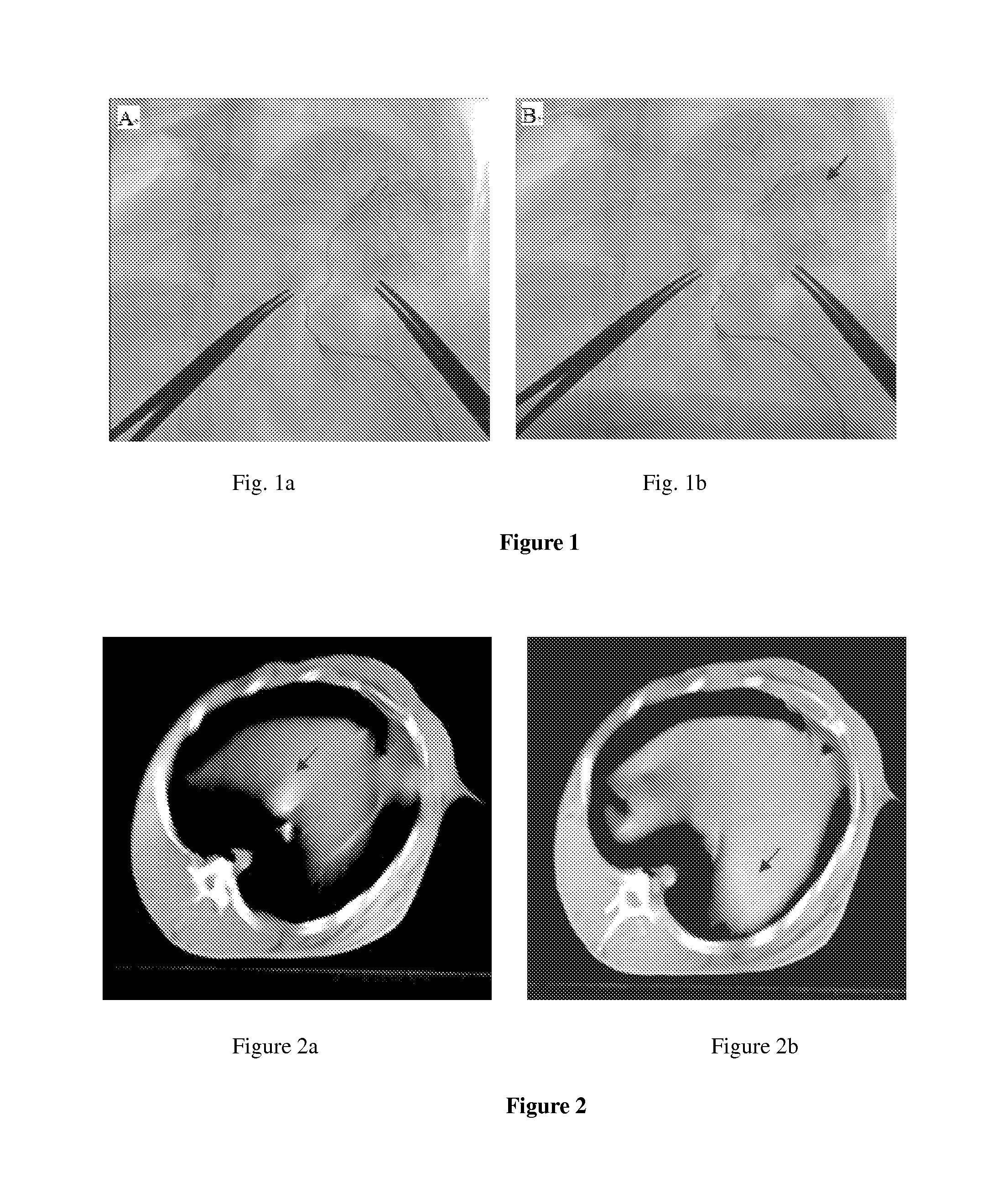 Vascular embolization gelling agent for sustained release of drugs for treating tumors and method for preparing the same