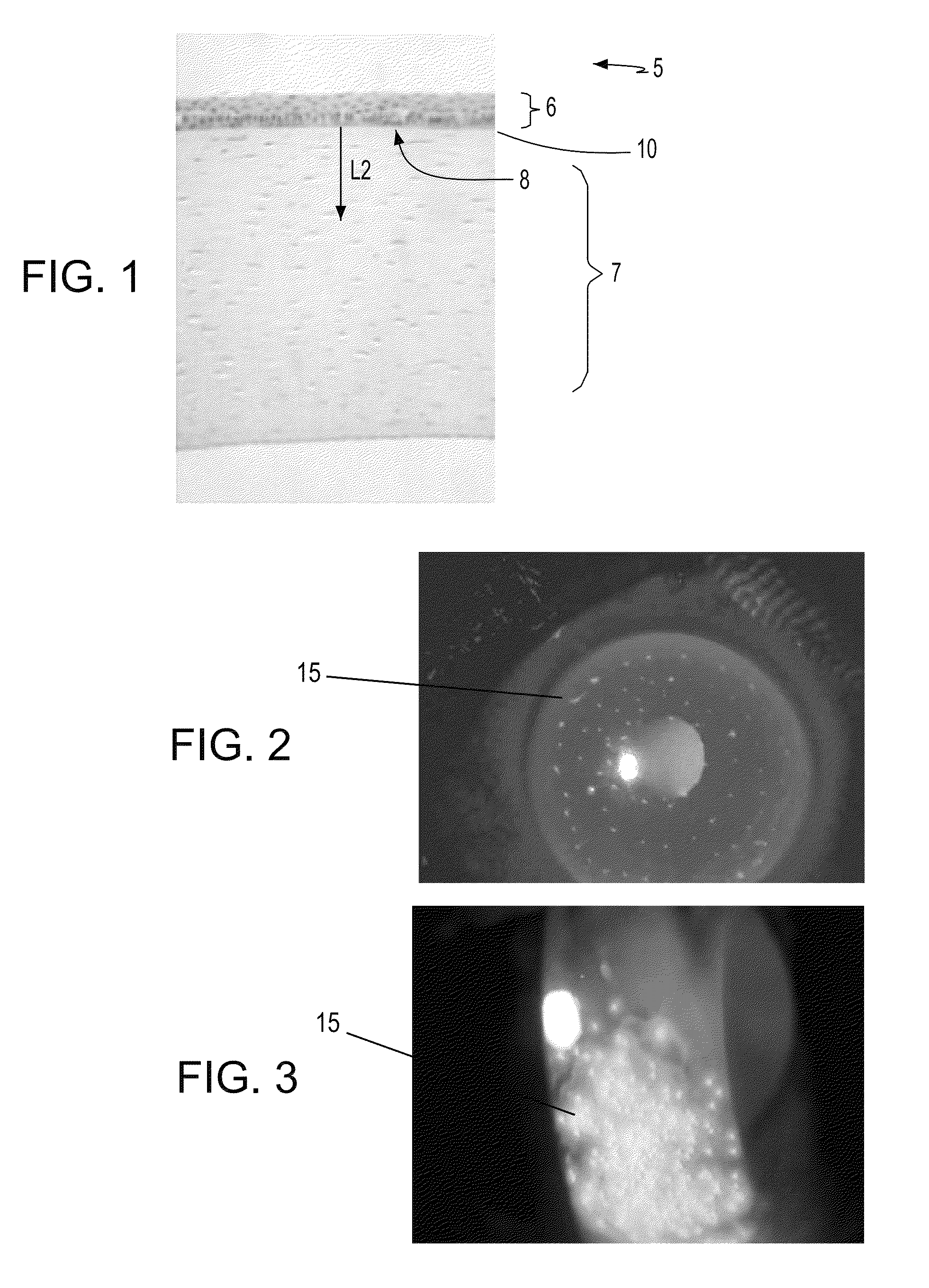Microfabricated instruments and methods to treat recurrent corneal erosion