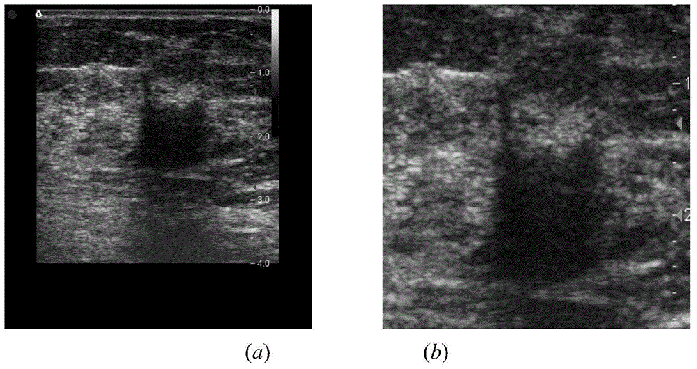 Breast neoplasms ultrasonic image segmentation method based on improved level set algorithm