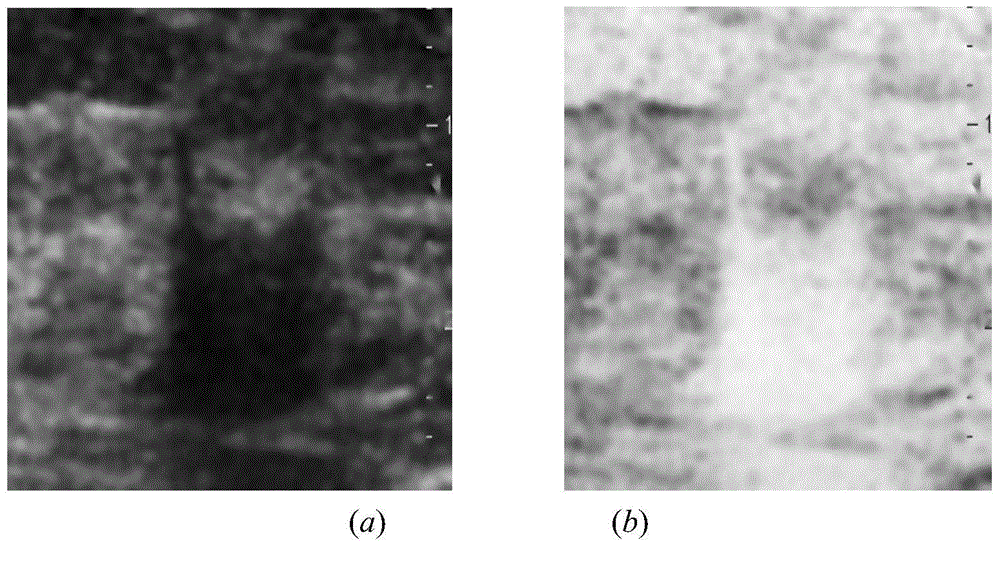 Breast neoplasms ultrasonic image segmentation method based on improved level set algorithm