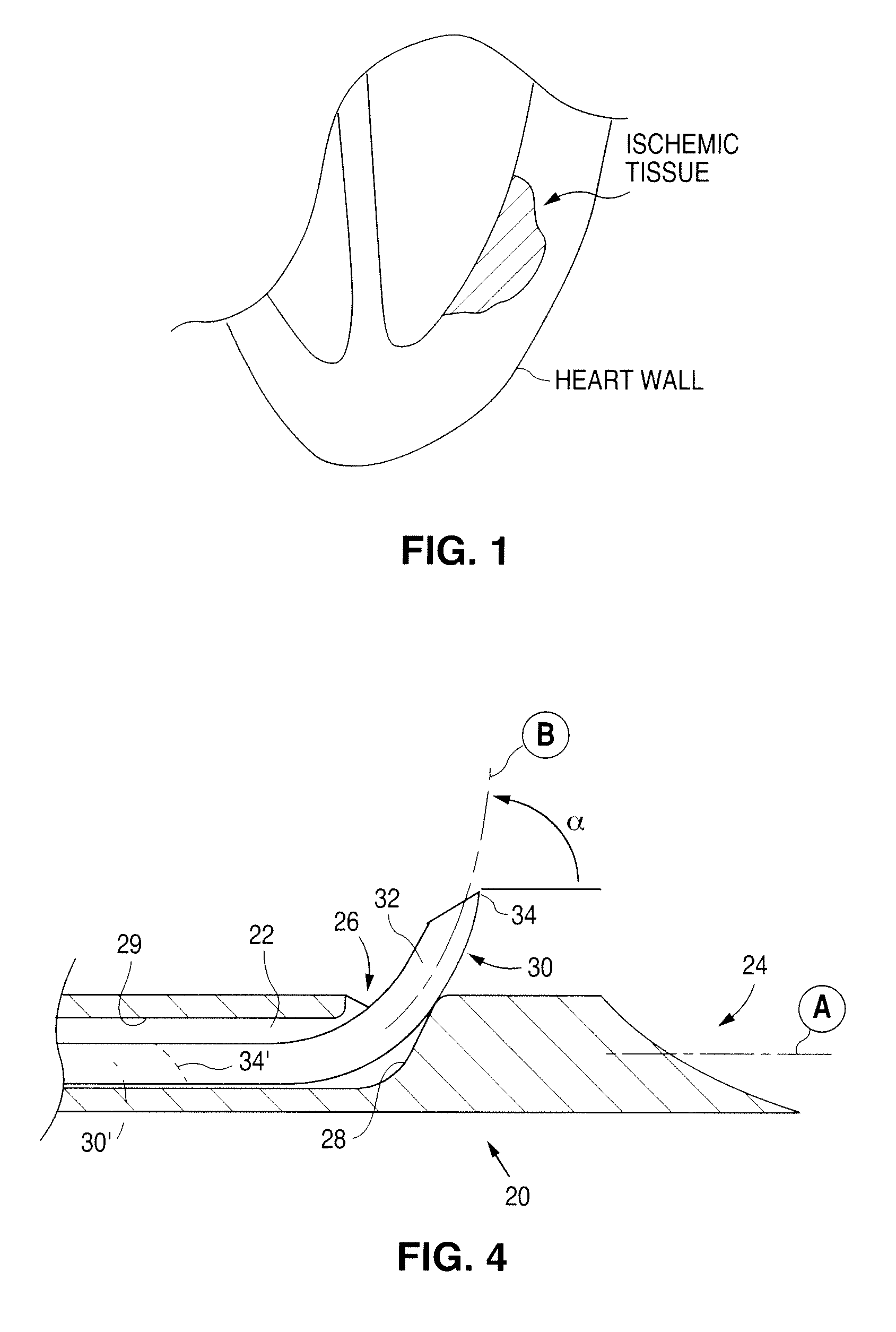 Agent delivery catheter including an anchor and injection needle