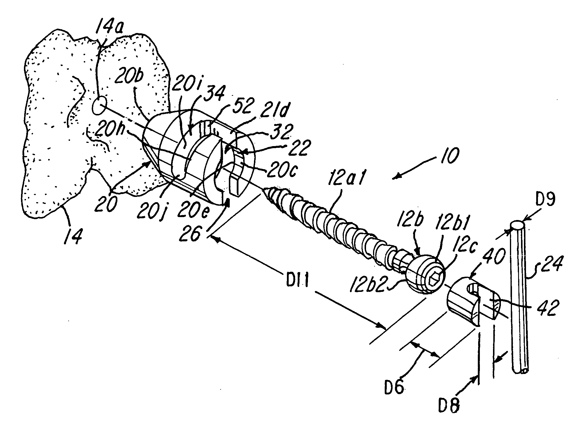 Capless multiaxial screw and spinal fixation assembly and method