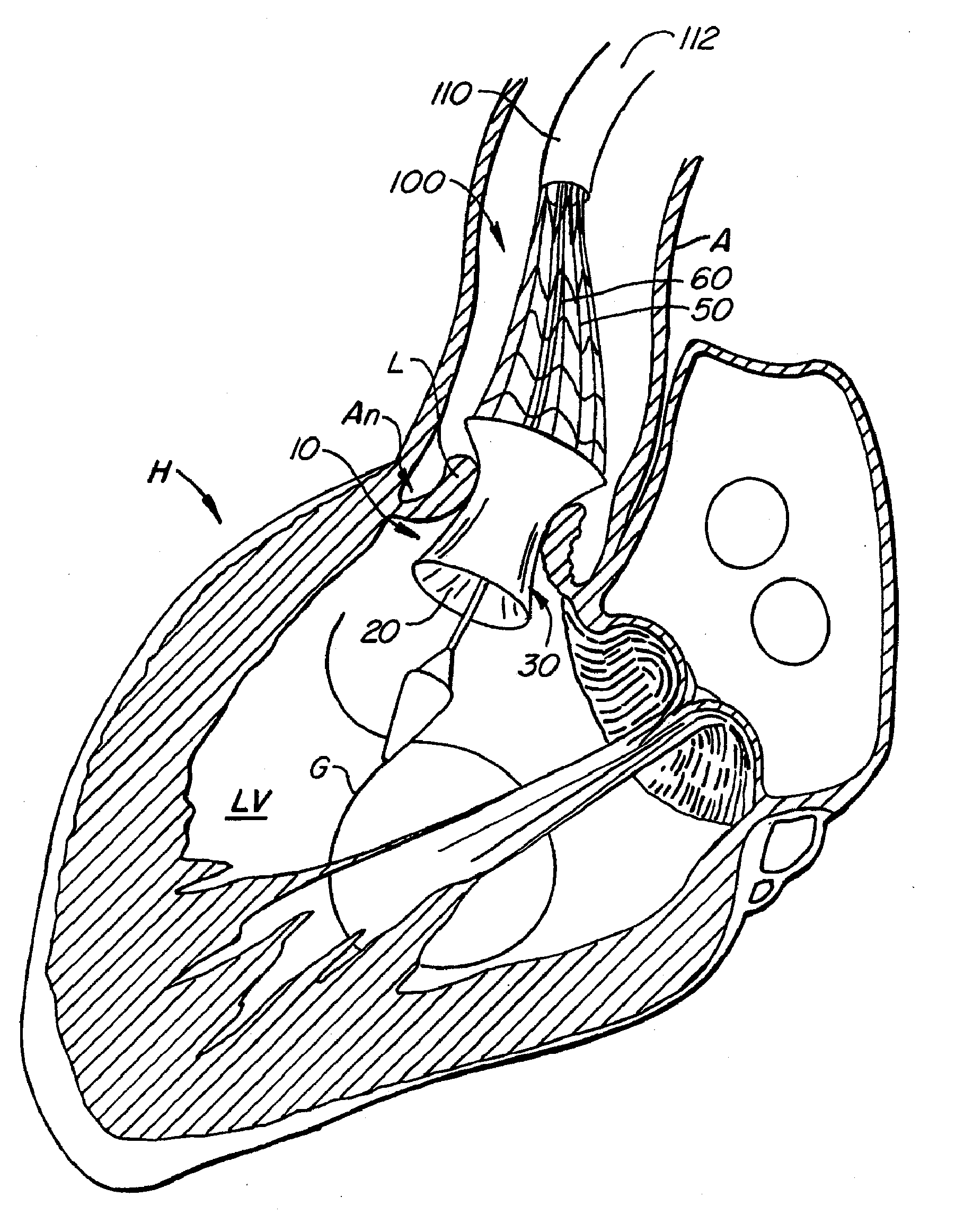 Externally Expandable Heart Valve Anchor and Method
