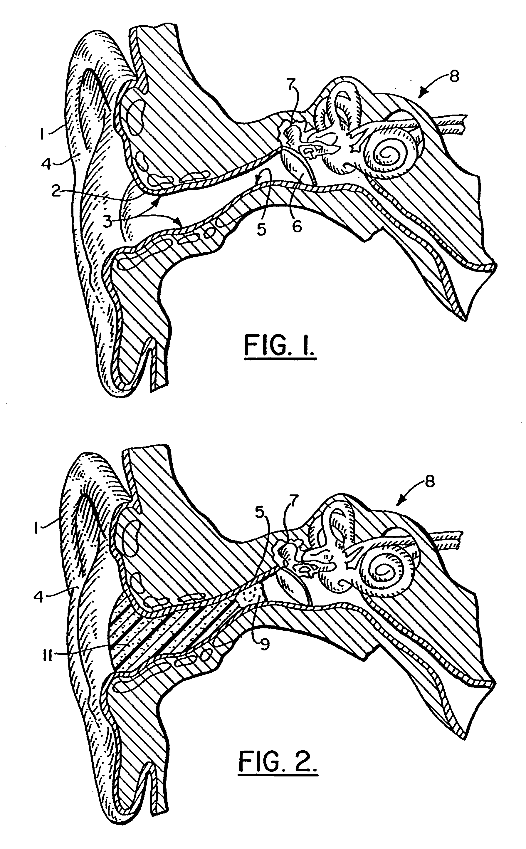 Method of manufacturing a soft hearing aid