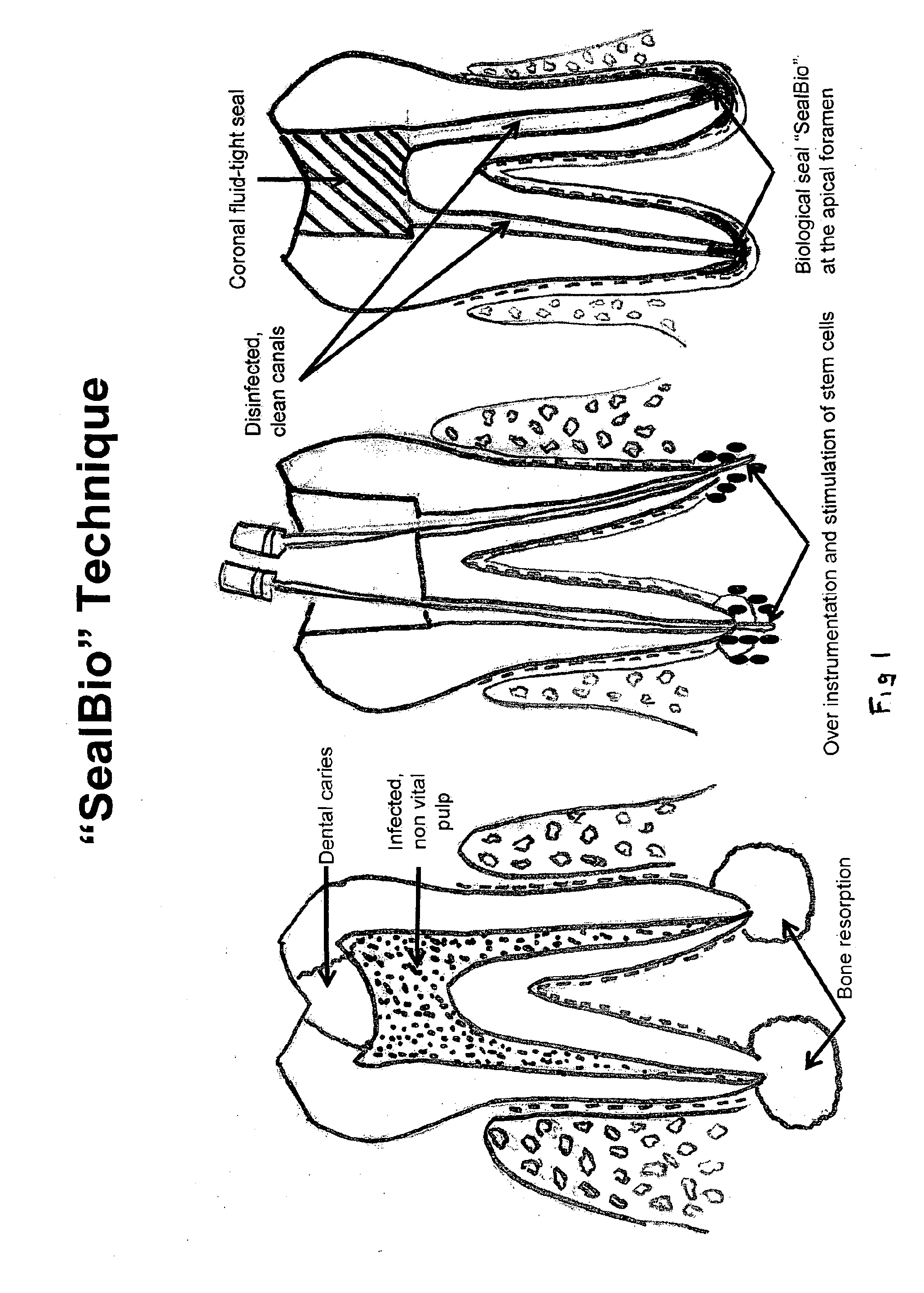 Sealbio:  a novel non-obturation regenerative technique of endodontic treatment