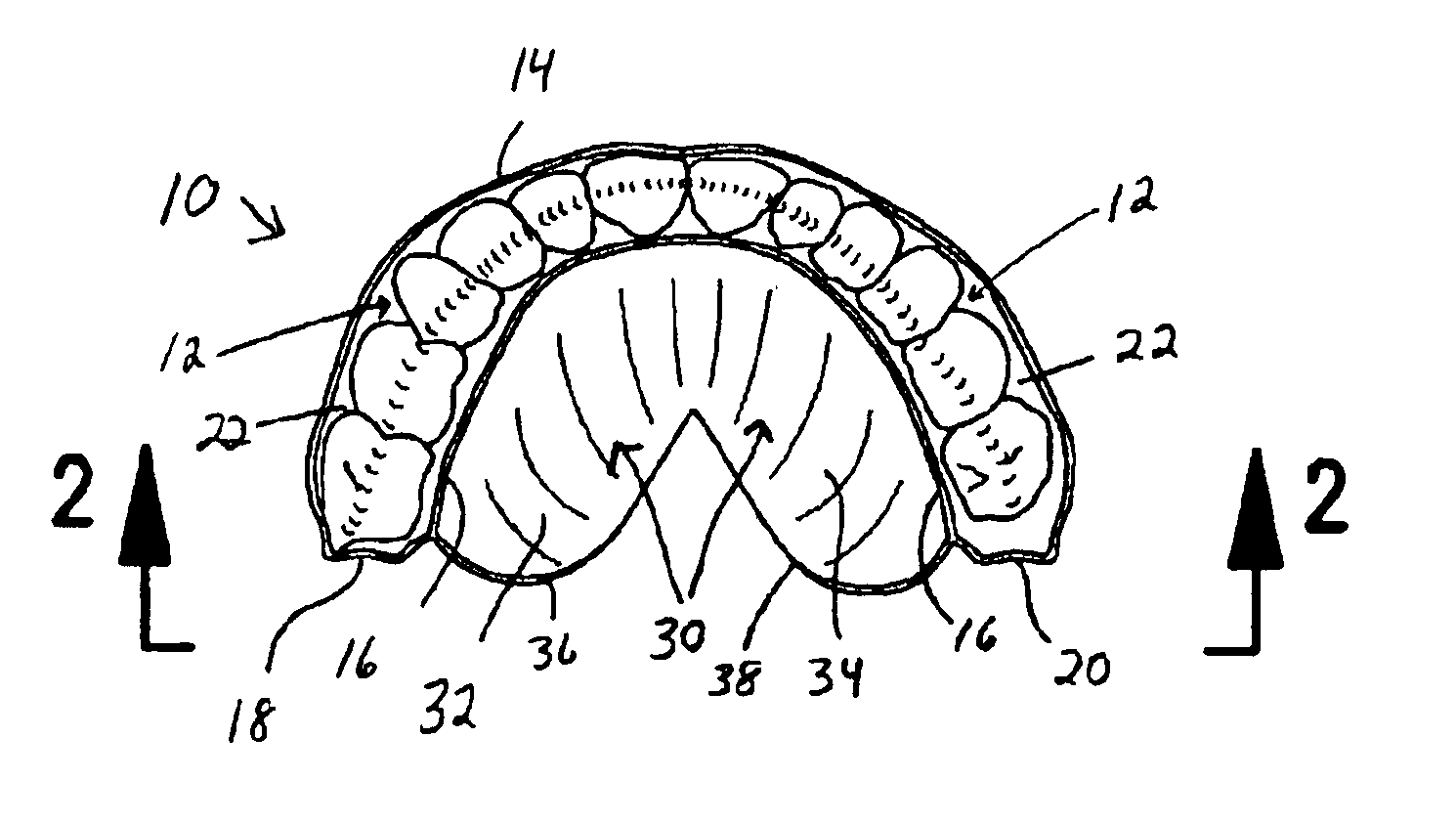 Tongue-airway appliance