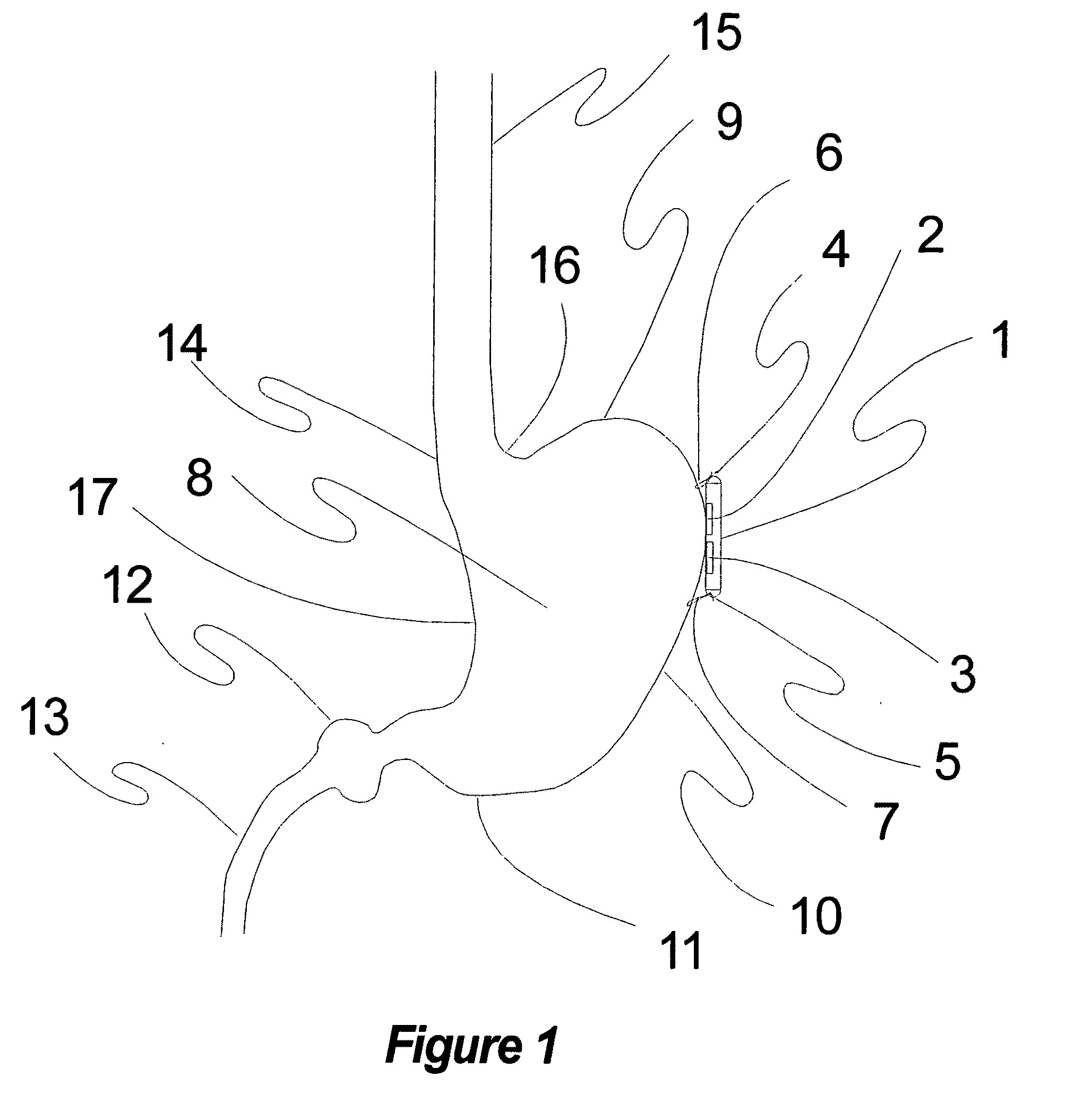 Method and apparatus for conformal electrodes for autonomic neuromodulation for the treatment of obesity and other conditions