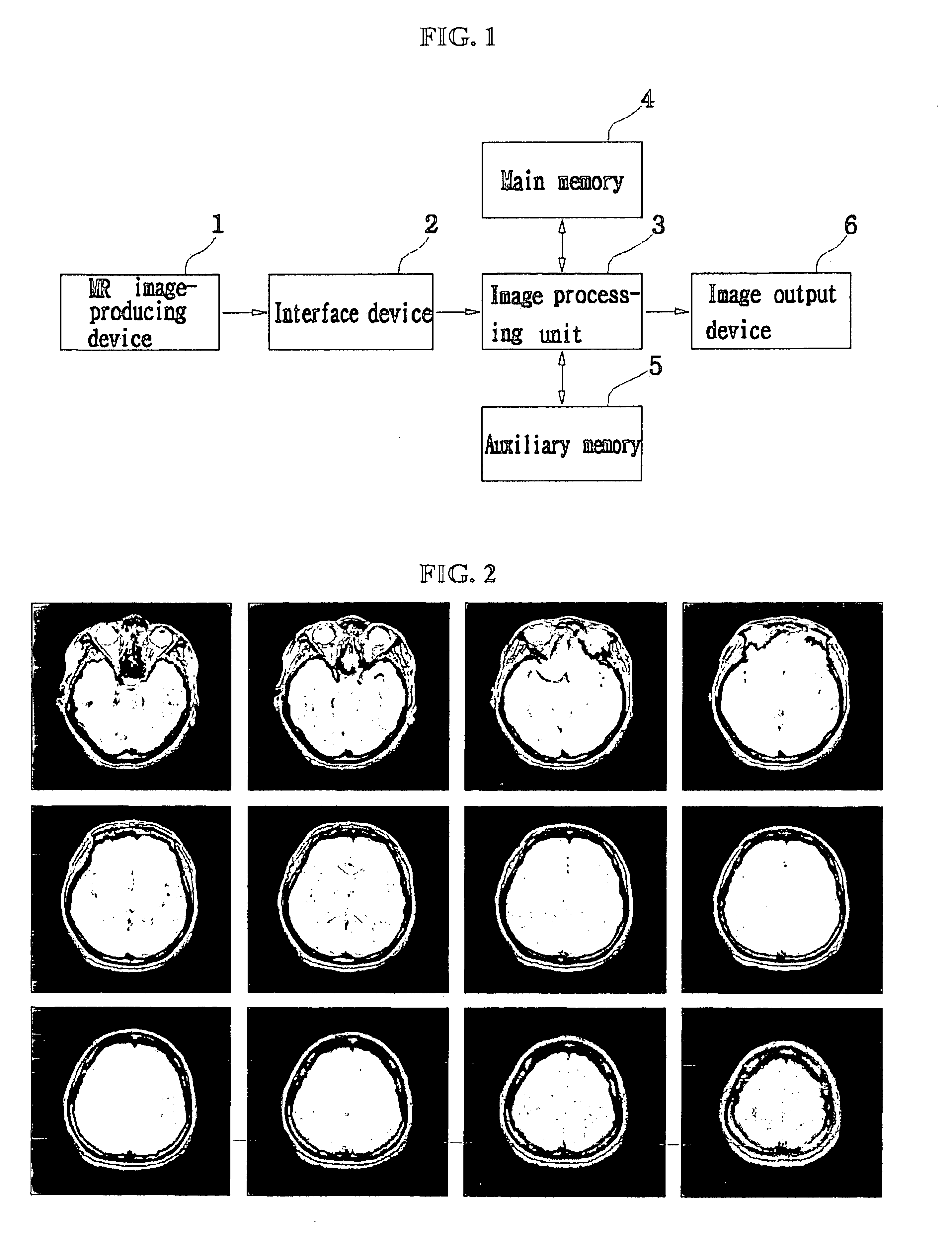 Method for segmentation and volume calculation of white matter, gray matter, and cerebral spinal fluid using magnetic resonance images of the human brain
