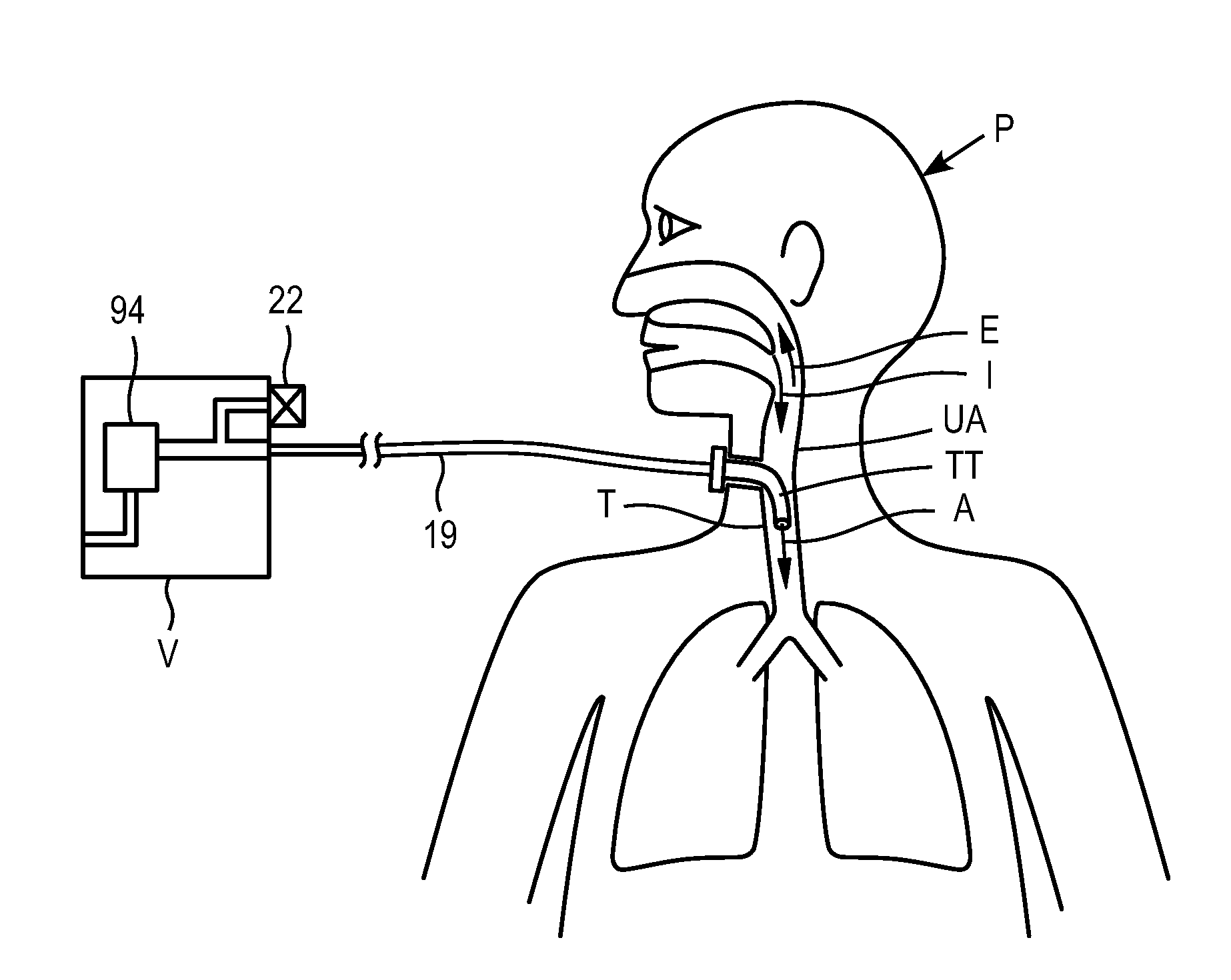 Methods and devices for providing inspiratory and expiratory flow relief during ventilation therapy
