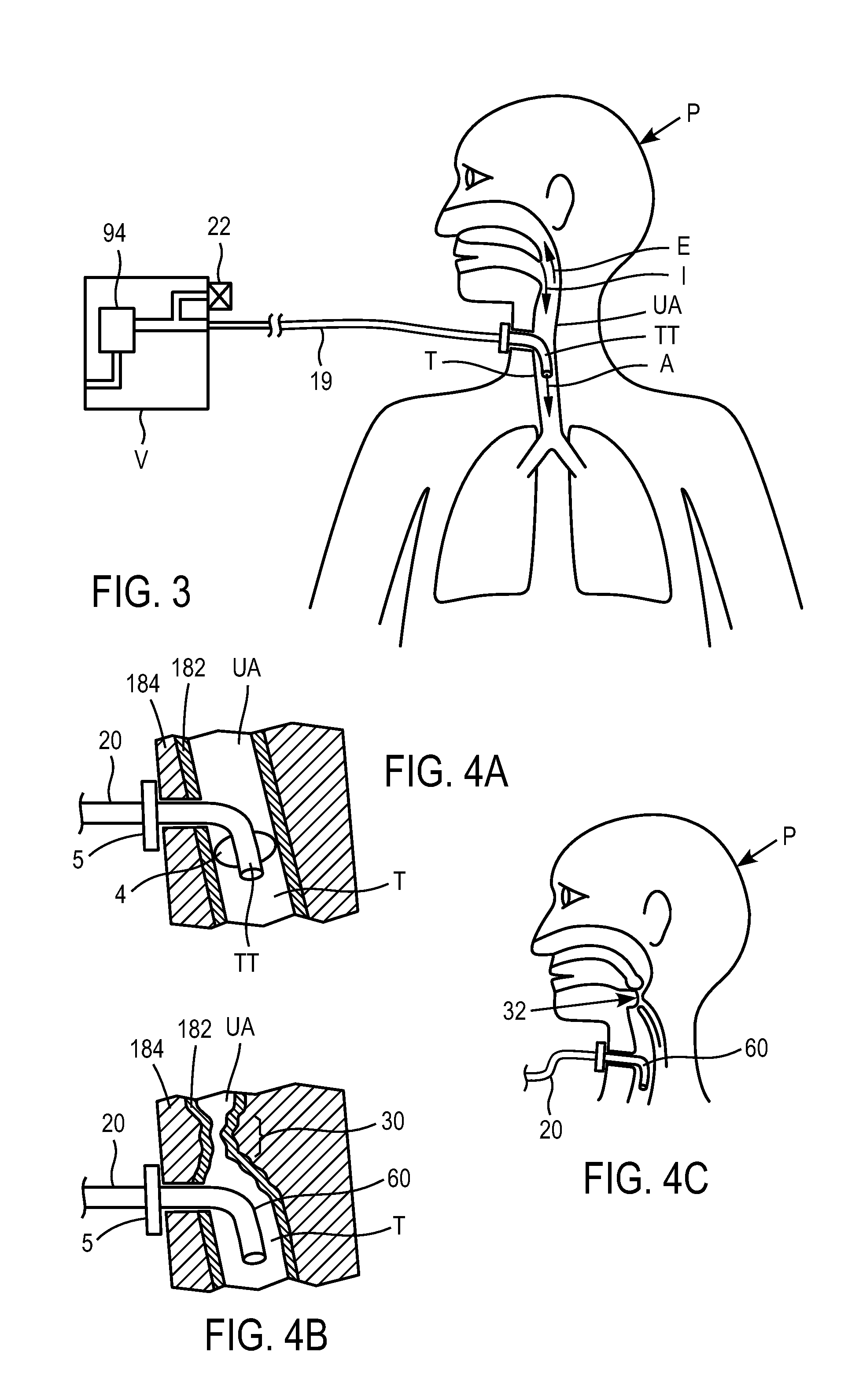 Methods and devices for providing inspiratory and expiratory flow relief during ventilation therapy