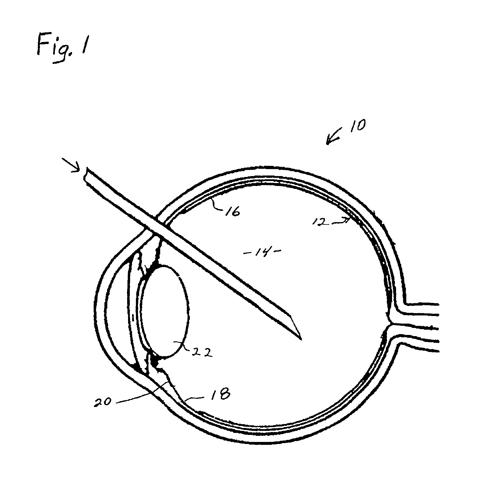 Process for generating plasmin in the vitreous of the eye and inducing separation of the posterior hyaloid from the retina
