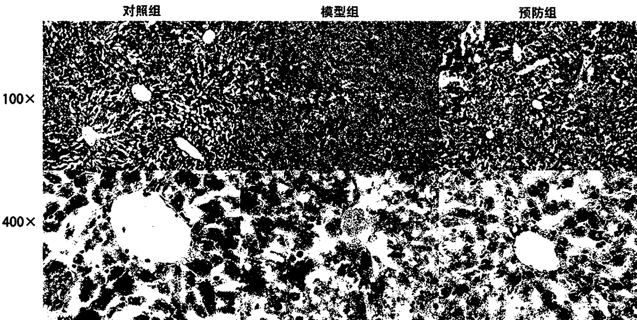 Chinese medicinal compound preparation for preventing non-alcoholic fatty liver disease