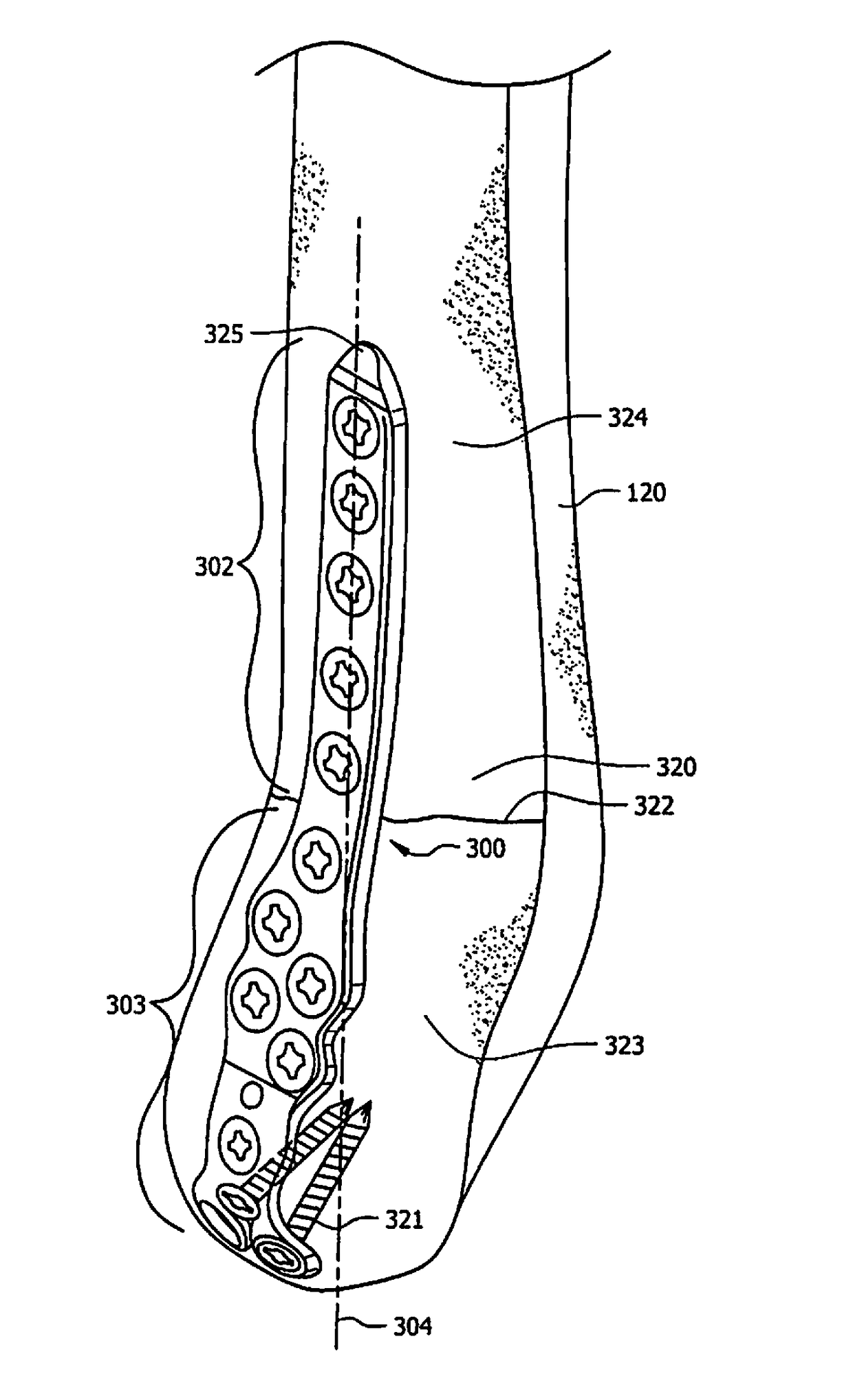 Ankle tibia plates