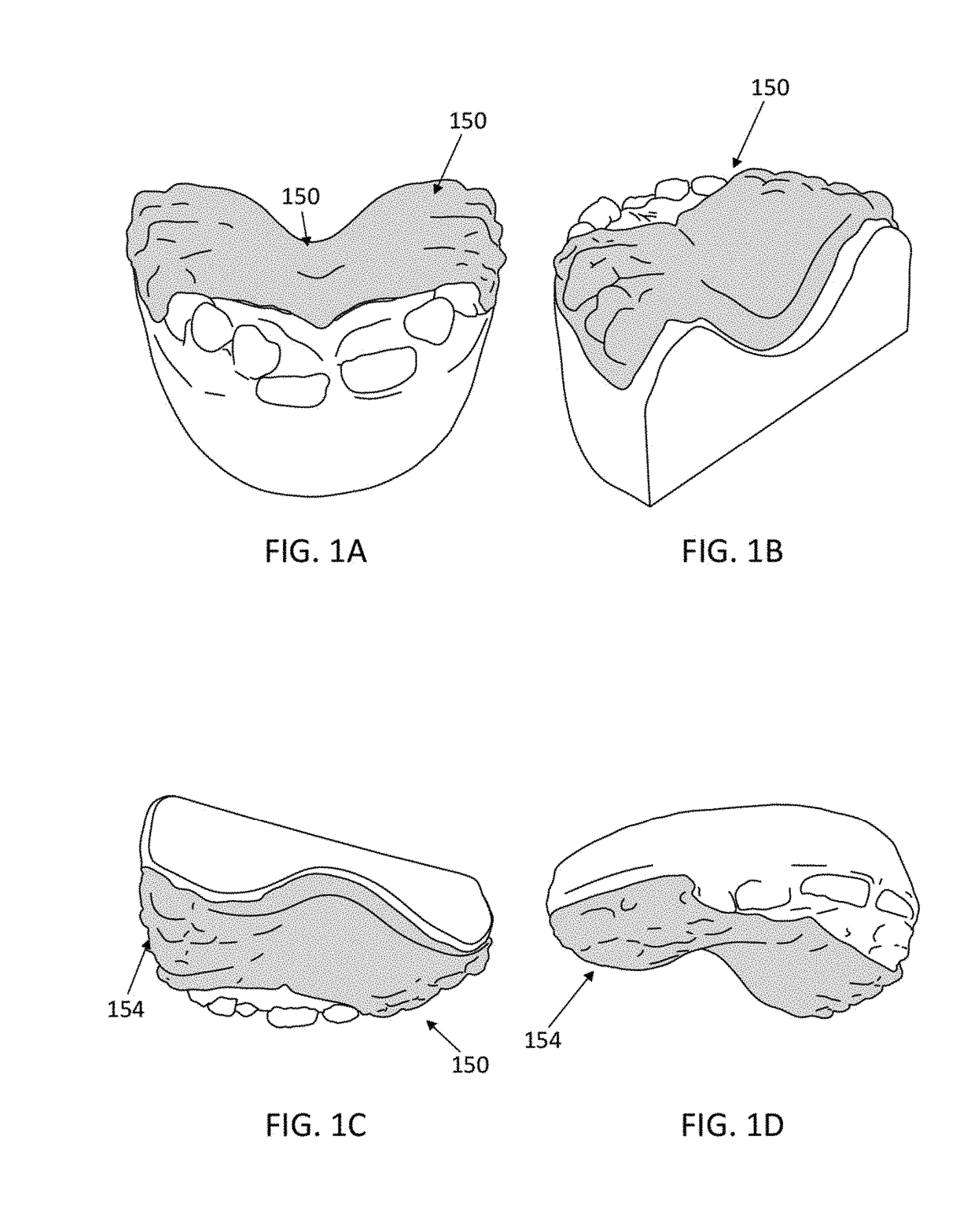 Palatal expanders and methods of expanding a palate