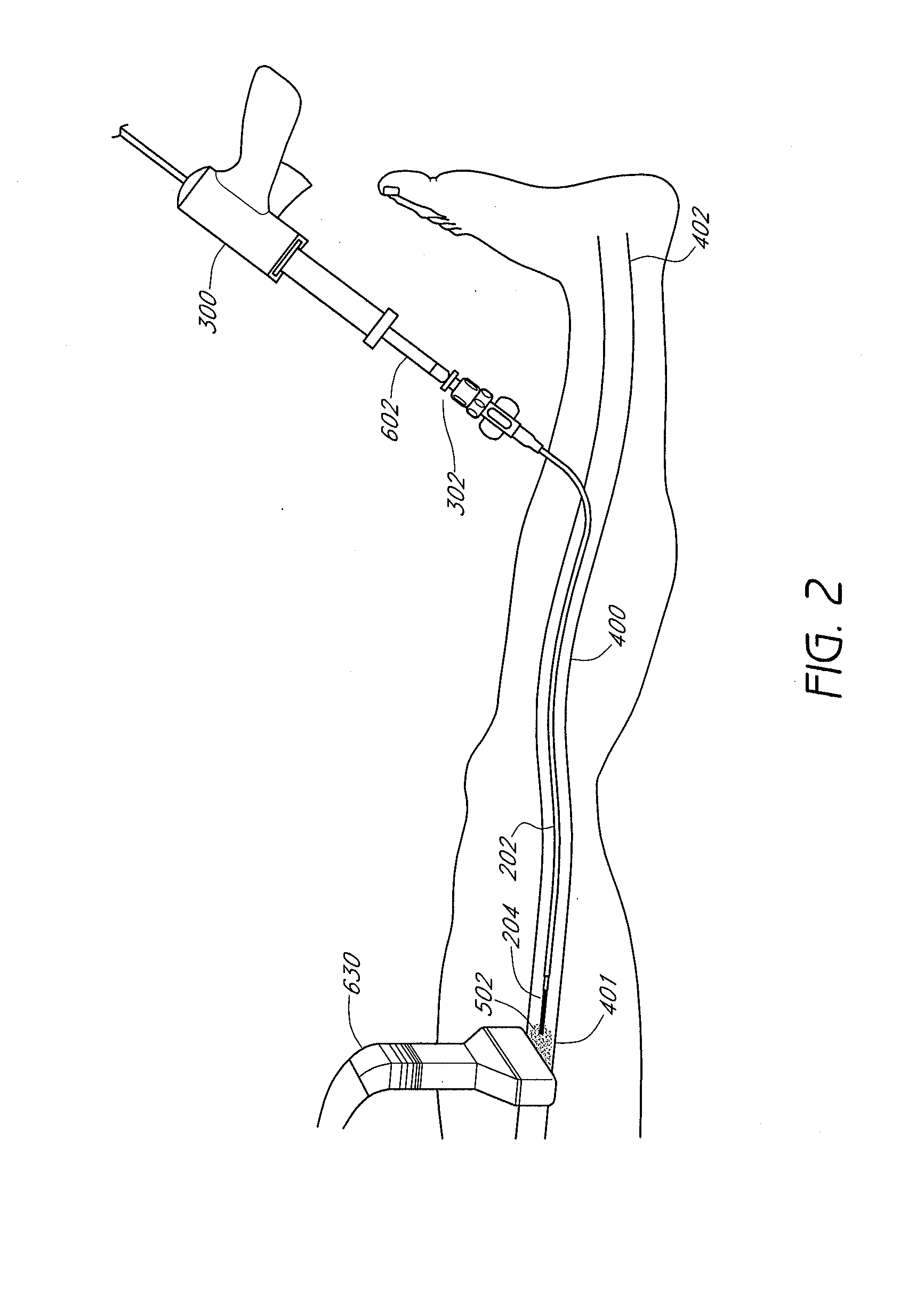 Systems and methods for treatment of perforator veins for venous insufficiency