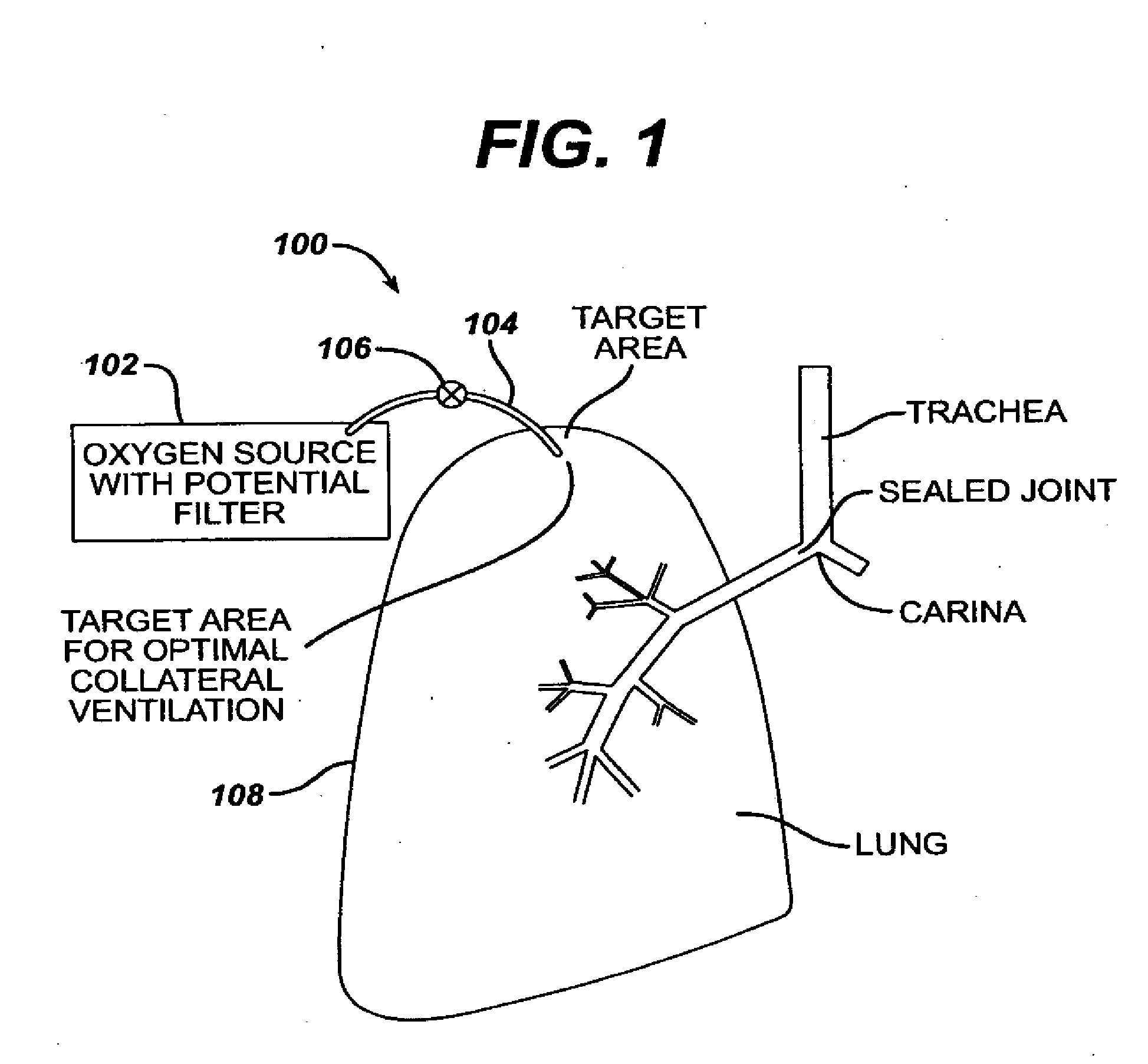 Lung reduction system