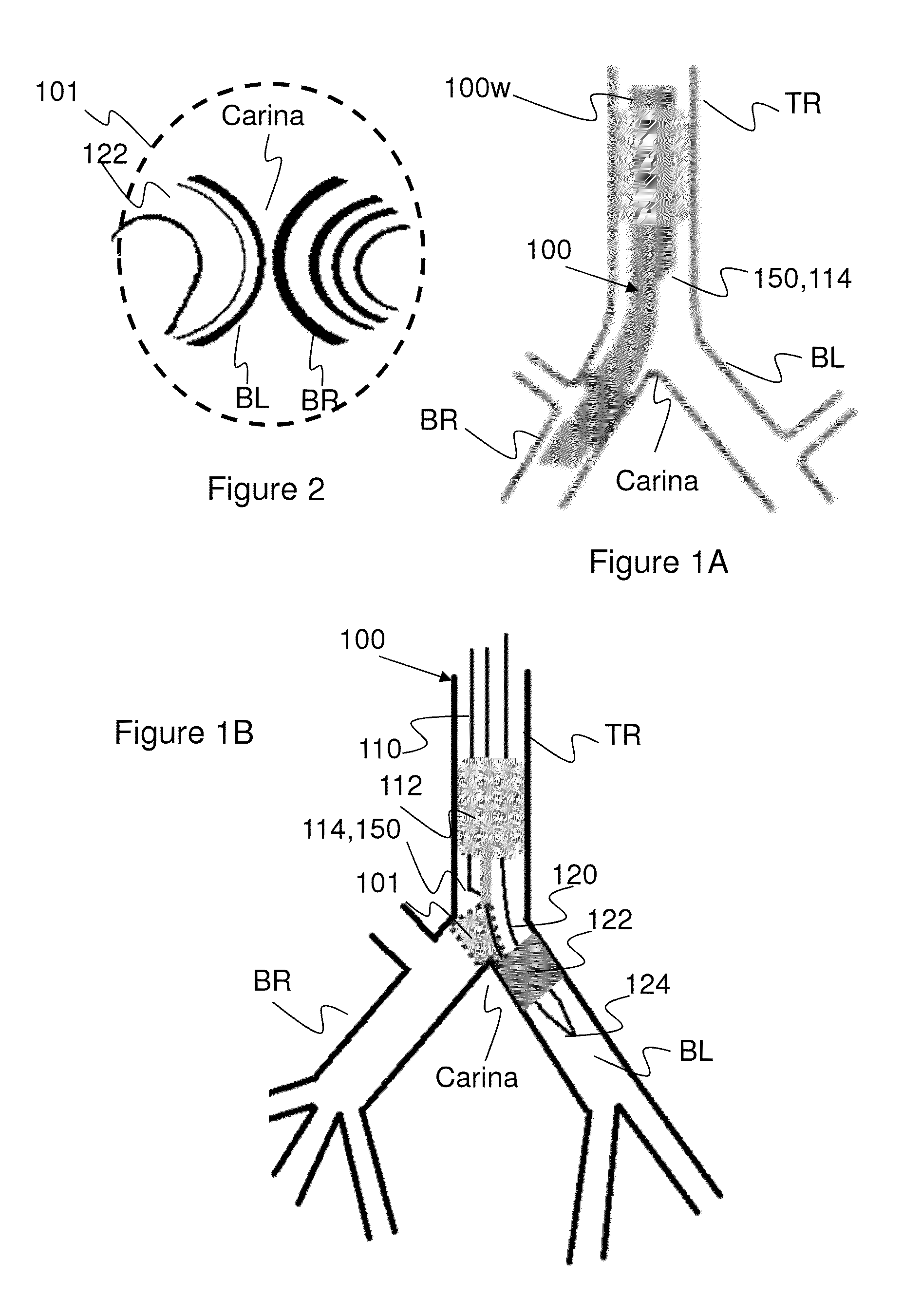 Endobronchial tube with integrated image sensor and a cleaning nozzle arrangement