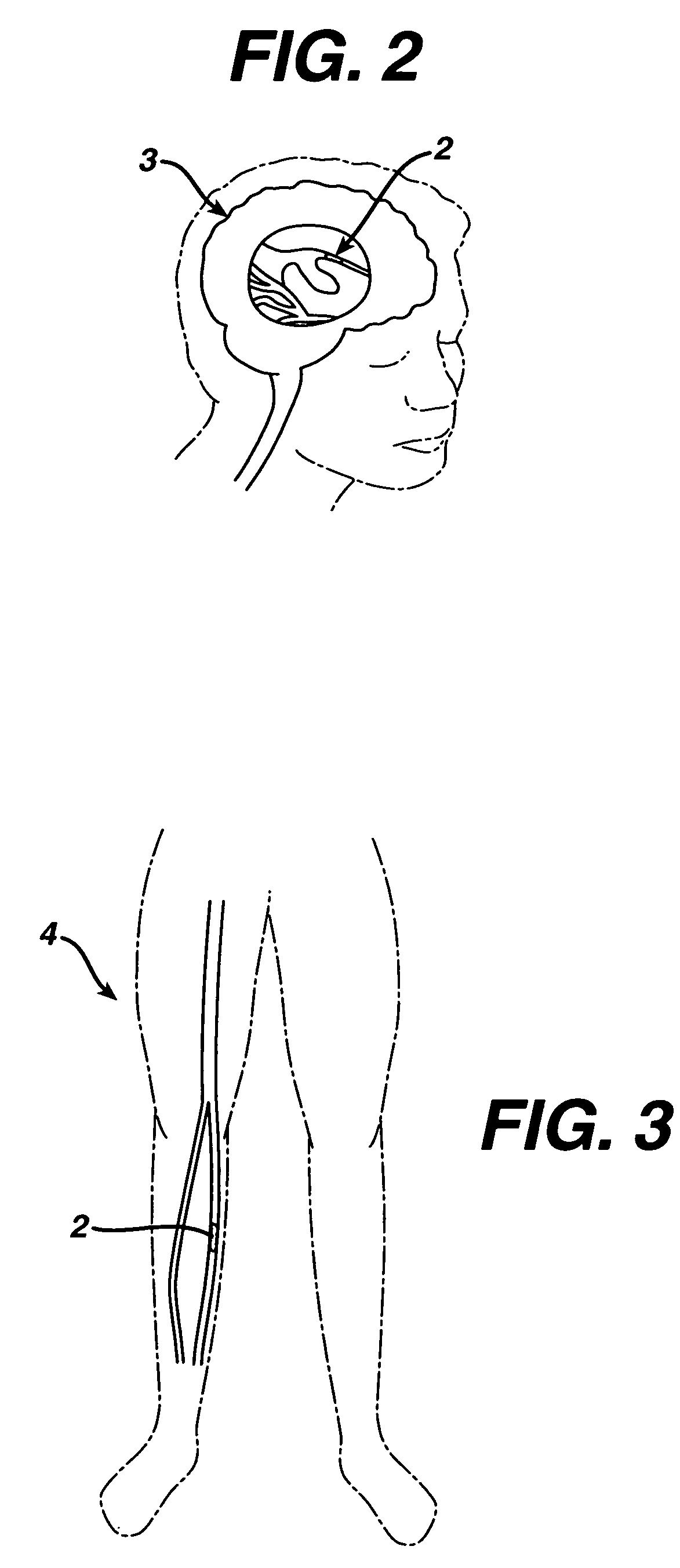 Systems and methods for treating a thrombus in a blood vessel