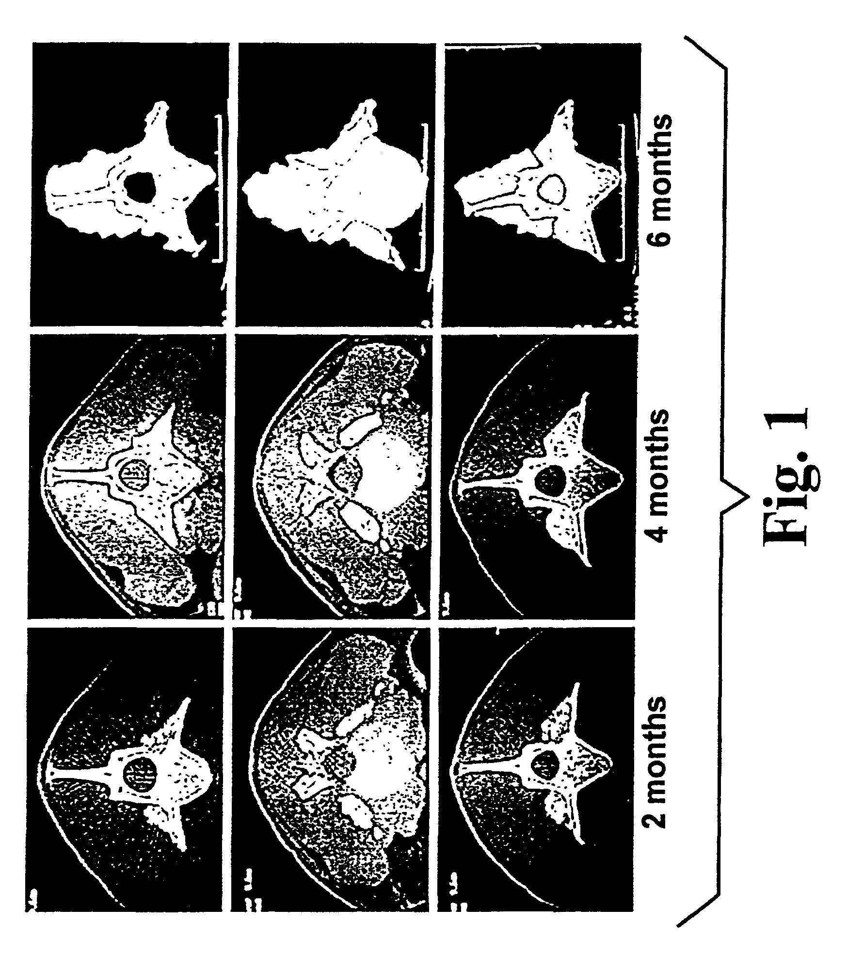 Highly mineralized osteogenic sponge compositions and uses thereof