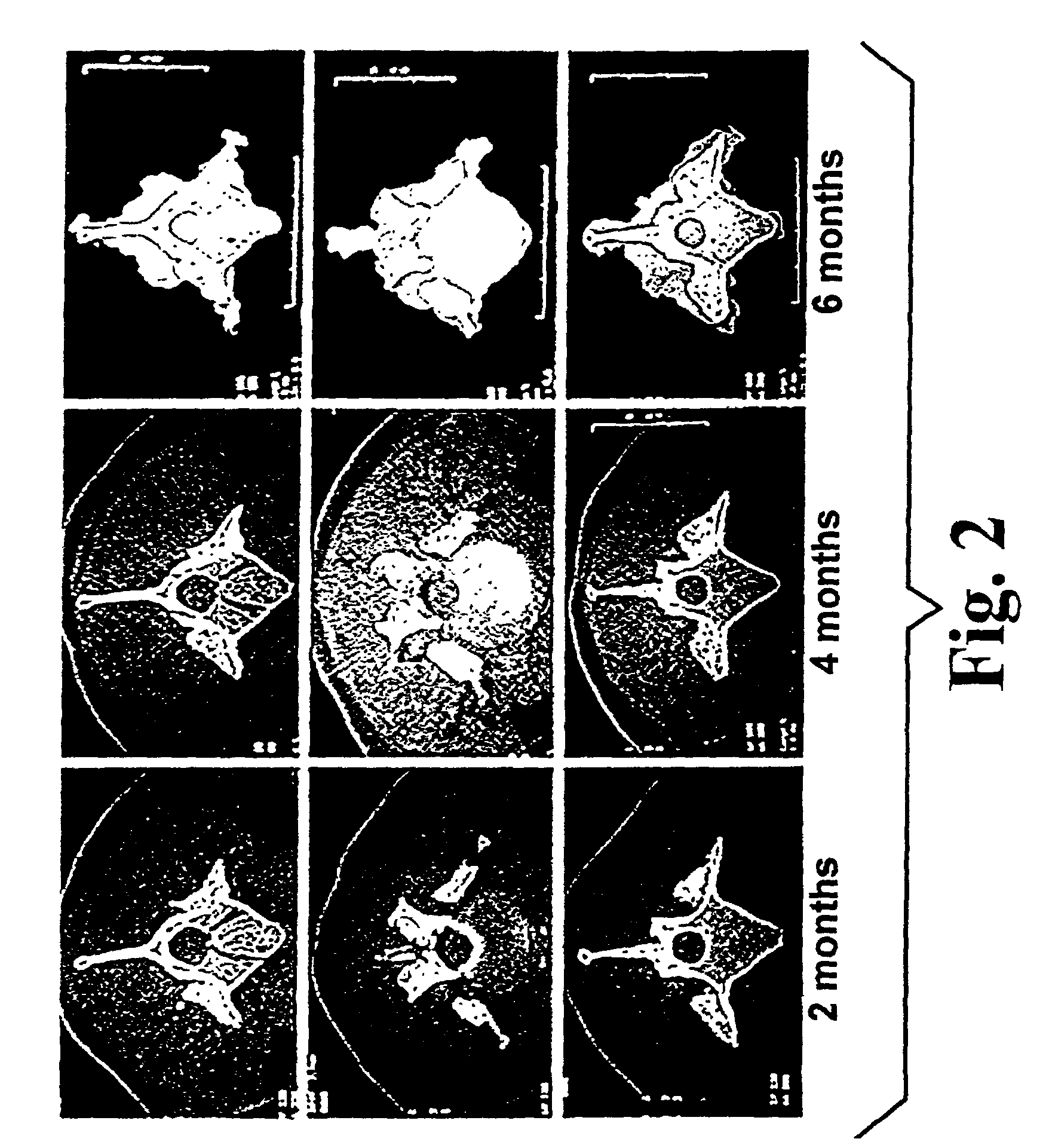 Highly mineralized osteogenic sponge compositions and uses thereof