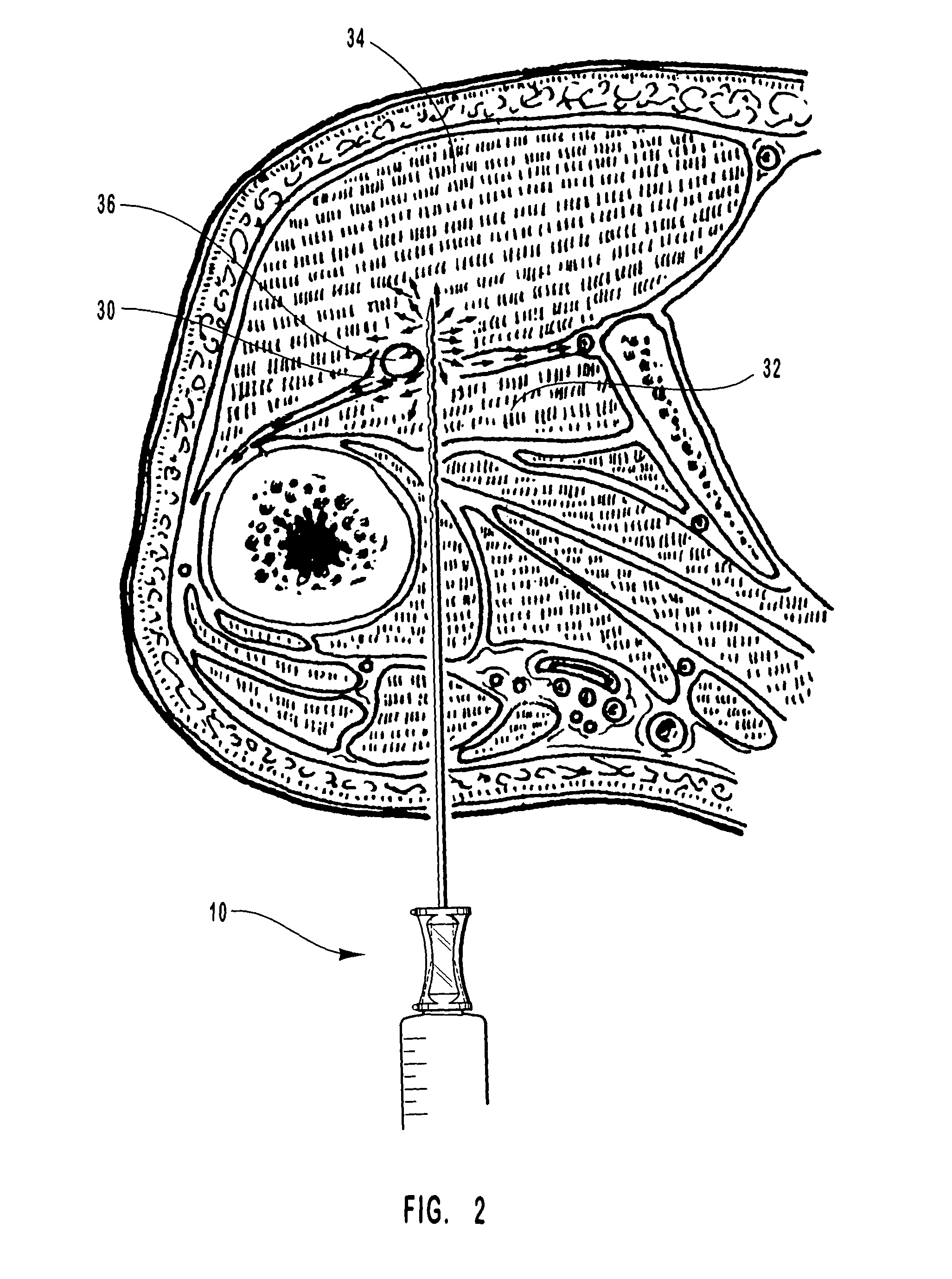 Fenestrated peripheral nerve block needle and method for using the same