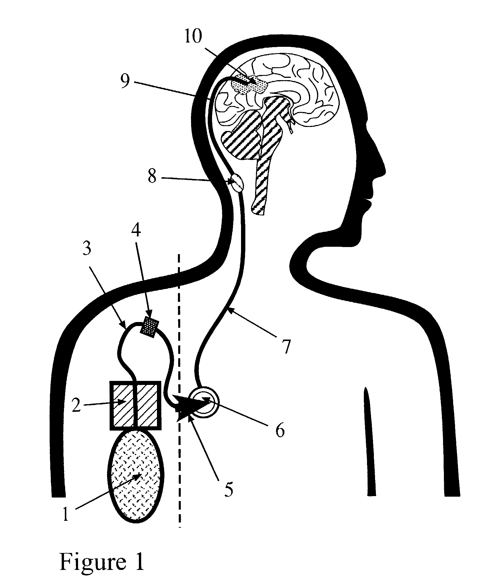 Portable equipment for administration of fluids into tissues and tumors by convection enhanced delivery technique