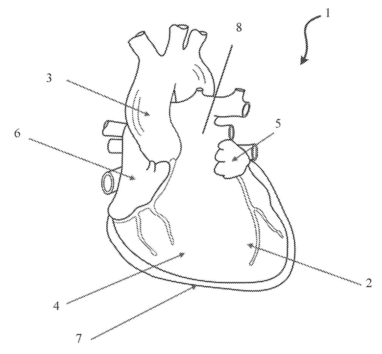 Epicardial heart rhythm management devices, systems and methods